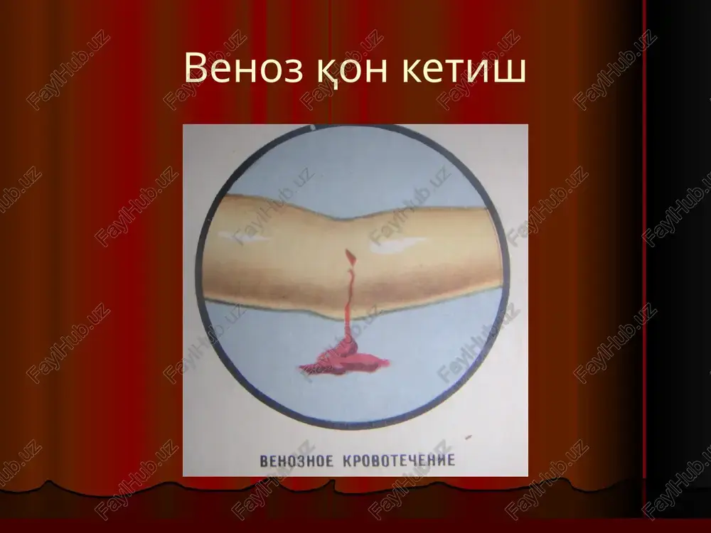 fastsiya qon va uning komponentlarini quyish: a. konservalangan qon b. yangi tsitratlangan qon v. qon plazmasi g. qon zardobi d. fibrinogen e. trombotsitar massa j. protrombinli kompleks vitaminlar yuborish: a. vitamin k (vikasol) b. vitamin s v. vitamin r (rutin) mushak orasiga odam yoki xayvon zardobini yuborish: a. ot zardobi b. odam zardobi qon komponentlarini maxalliy qo'llash: a. trombin b. gemostatik gubka v. fibrin gubkasi g. fibrin pardasi d. quruq plazma e. biologik antiseptik tampon. image1.jpeg image2.jpeg image3.jpeg image4.jpeg image5.jpeg image6.jpeg image7.jpeg image8.jpeg image9.jpeg image10.jpeg image11.jpeg image12.jpeg image13.jpeg image14.jpeg image15.jpeg image16.jpeg image17.jpeg image18.jpeg image19.jpeg image20.jpeg image21.jpeg image22.jpeg image23.jpeg image24.jpeg image25.jpeg image26.jpeg image27.jpeg image28.jpeg