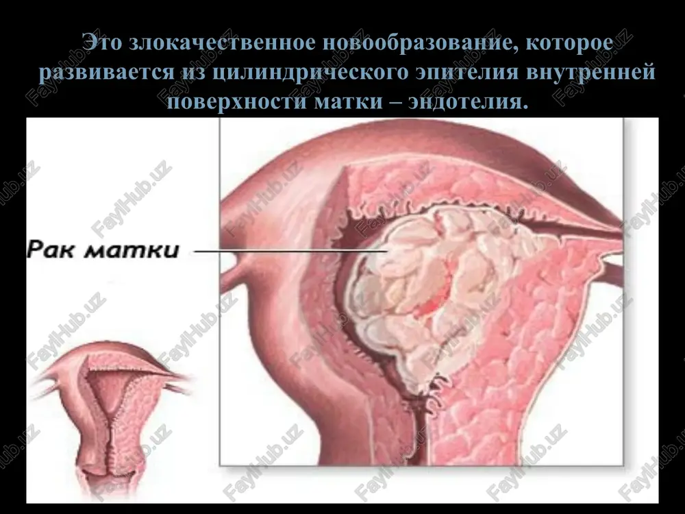 roskopiya s biopsiey endometriya gisterosalpingografiya, pnevmopelviografiya kt,mrt angio i lifografiya aspiratsionnaya biopsiya i tsitologicheskoe issledovanie biopsiya endometrialnie polipi uzi kartina jelezisto-kistoznaya giperplaziya endometriya. polip endometriya. kt i mrt xirurgicheskoe luchevaya terapiya – pred i posleoperatsionnaya ximioterapiya – adyuvantnaya i neoadyuvantnaya gormonalnaya terapiya – pri gormonozavisimom rake lechenie xirurgicheskoe lechenie ob'em xirurgicheskogo vmeshatelstva opredelyaetsya stadiey protsessa i prognozom. pri blagopriyatnom prognoze provoditsya ekstirpatsiyu matki s pridatkami, a pri neblagopriyatnix — rasshirennaya ekstirpatsiya - pangisteroektomiya (issechenie odnim kompleksom matki, pridatkov, parametralnoy kletchatki i vsex regionarnix limfouzlov) operatsiya ne primenyaetsya tolko v sluchae absolyutnix protivopokazaniy – rasprostranennix metastazov, nekompensirovannoy poliorgannoy i drugoy ekstragenitalnoy patologii drugix tyajelix sostoyaniy pri kotorix bolnaya perevoditsya na palliativnoe lechenie. ob'em xirurgicheskogo vmeshatelstva prognoz protsentnoe sootnoshenie 5-letney vijivaemosti v zavisimosti ot stadii raka pervichnaya profilaktika raka tela matki. kontrol gormonalnogo statusa, dieti, tshatelnaya otsenka pokazaniy k naznacheniyu gormonosoderjashix preparatov. kontrol za kantserogenami okrujayushey sredi (nekotorie pestitsidi obladayut gormonopodobnim deystviem). …