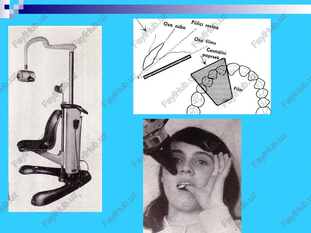 – fh (simon bo'yicha) ko'z or nuqtasini (orbitaning pastki qirg'og'i) quloq nuqtasi ro birlashuvi. spinal tekislik – spp bu spina nasalis anterior dan spina nasalis posterior ga o'tuvchi chiziq. spinal tekislikni schwarz yuqori jag'ni asos tekisligi deb xisoblagan. okklyuzion tekislik – osr yuqori va pastki jag' tishlarni jipslashuv yuzasiga mos keluvchi chiziq. bu tekislik kurak tishlarni kontakt, jag' tishlarni okklyuzion yuzasidan o'tadi. mandibulyar tekislik - mr yoki pastki jag'ni asos tekisligi. (gn orqali va pastki jag' tanasini pastki konturida bu tekislik joylashgan). burun vertikal - pn yoki burun tekisligi, dreifus tomonidan tavsiya etilgan, bu, kalla asosi tekislikgiga perpendikulyar tushirilgan, ya'ni kranial tekislik n-se n nuqtasidan (teri burun nuqtasidan). orbital vertikal - por yoki dreyfus orbital tekisligi – ko'z kosasini osti qirg'og'idan burun vertikaliga parallel o'tadi. spinal tekislik va pastki jag' tekisligi mr oralisida yuz-jag' kompleksi joylashgan. kalla suyaklariga nisbatan jaglarni joylanishi schwarz buyicha kuyidagilar yordamida aniqlanadi: - yuz burchaki f …