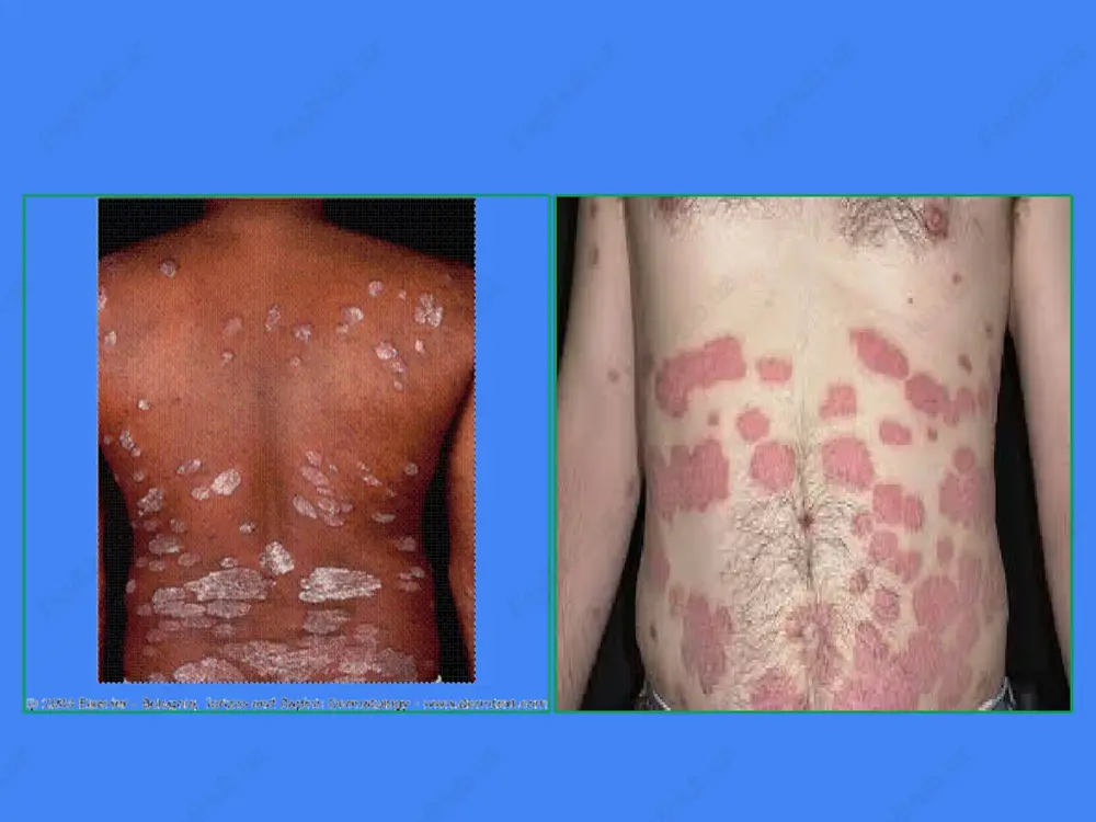 kichish bilan (progressiv davrida) va teri tortilishi bilan kechadi. toshmalarning ulchami va toshish xarakteriga karab uning kuyidagi klinik formalari tafovut etiladi. 1.nuktali psoriaz--psoriazis punktata. bunda toshmalar ulchami tugnogich boshidek yoki tarik donasidek buladi. 2.tomchisimon psoriaz—psoriazis guttata yoki lentikulyaris toshmalar yasmik donasi ulchamigacha etadi. 3.tangasimon psoriaz—psoriazis nummularis toshmalar 3-5 tiyinlik tangacha buladi. 4.psoriazis lixenoidis spinuloza—lixenoid papulalar bilan namoyon buladi. 5.psoriazis papillamatoza yoki verrukoza—papillamatoz usuvchi uchoklar xosil buladi. 6.psoriazis annularis yoki orbikularis—toshmalar xalka xosil kiladi (xalkasimon psoriaz) 7.psoriazis girata—toshmalar yoy yoki girlyand kurinishida buladi. 8.psoriazis figurata yoki geografika—uchoklar geografik kartani eslatadi. 9. psoriazis seborroika—toshmalar seboreya uchraydigan soxalarda kichik pushti kipiklanuvchi doglar kurinishida buladi. 10.psorazis inveterata ekzematizata—«eski», ekzematizatsiyalashgan psoriaz. boshning sochli kismida kupincha sillik terini xam kamrab oluvchi diffuz kipiklanish yoki anik chegaralangan kipiklar tuplami kuzatiladi. ammo soch xech kachon shikastlanmaydi. psoriaz 25% xollarda boshning sochli kismidan boshlanib, 60% xollarda terining boshka soxalarini xam shikastlaydi. jinsiy a'zolarda esa 20% xollarda asosan yosh kizlarda …