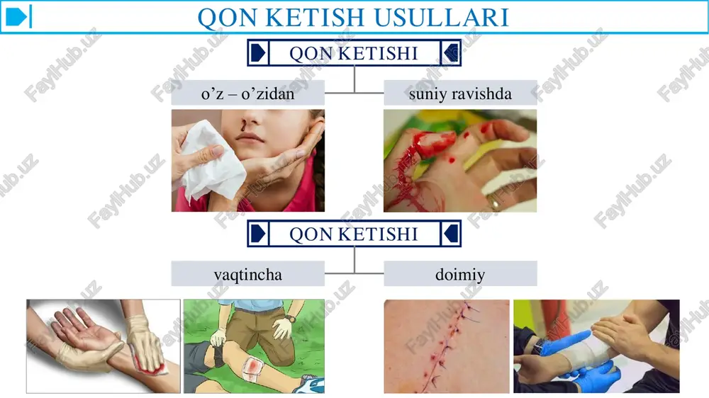 bo'shlig'iga (masalan, taloq olib tashlanganda, uning o'rnidan qon ketsa) doka tampon tikib qo'yiladi. qon oqayotgan tomir ma'lum bo'lmasa, ko'pincha doka yoki bintdan tayyorlangan ingichka tamponlar batamom qon ketishini to'xtatishning birdan-bir yo'li hisoblanadi. masalan, bu usul vena sinuslari va chigallaridan, qin, burun va suyak bo'shlig'idan, milklardan qon ketganda yaxshi ta'sir ko'rsatadi. abu ali ibn sino «tib qonunlari» ning iv kitobida yaradan qon ketganda tamponlardan foydalanganini, ularni olib tashlashda organizm asta-sekin o'zi tashqariga itaradi, deb eslatib o'tadi. qo'yilgan tampon to'qimalarni ezib turishi sababli 48 soat dan uzoq muddat qo'yilmasligi kerak, uni antiseptik moddalar qo'llab, shilliq qavatni shikastlantirmasdan avaylab olinadi. qorin bo'shlig'iga qo'yilgan tampon birdaniga olib tashlanmaydi, avval u o'rnidan siljitiladi, keyingi kunlarda sekin tortib olinadi, bunda bemorga og'riq qoldiruvchi moddalar qilinadi. qon ketishini to'xtatishning termik usullari past haroratdan qonni to'xtatish uchun foydalanish qadimdan ma'lum. ko'pincha rezina idishga sovuq suv, qor yoki muz to'ldirilib shikastlangan sohaga qo'yiladi. past harorat tomirlar devorini toraytiradi, tromb …