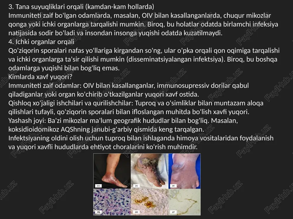 uvi ba'zi hollarda qo'ziqorin infeksiyasi suyaklarda, bo'g'imlarda yoki terining chuqur qatlamlarida absess hosil qilsa, jarrohlik yo'li bilan infeksiyalangan to'qimalarni olib tashlash kerak bo'lishi mumkin. jarrohlik ba'zida og'ir organik zararlanish bo'lganida, masalan, o'pka yoki miya infeksiyalari paytida qo'llaniladi. 3. immunitetni qo'llab-quvvatlash immuniteti pasaygan bemorlarda (masalan, oiv bilan kasallanganlar yoki immunosupressiv dorilar qabul qilayotganlar) antifungal dorilar bilan bir qatorda asosiy kasallikni davolash ham muhimdir. immunitetni oshiruvchi terapiyalar (masalan, oiv davolash uchun antiretrovirus dorilar) infeksiyaga qarshi kurashda yordam beradi. davolashning davomiyligi chuqur mikozlarni davolash uzoq muddatli bo'lishi mumkin, ba'zi hollarda bir necha oydan bir yilgacha davom etadi. bu vaqt davomida bemorlar dori-darmonlarni qat'iy ravishda qabul qilishlari kerak, chunki davolashni erta to'xtatish infeksiyaning qaytalanishiga olib kelishi mumkin. davolash paytida muntazam tibbiy nazorat va laborator tekshiruvlar o'tkazilishi zarur bo'lib, bu dorilarning samaradorligi va yon ta'sirlarini kuzatish uchun muhimdir. e’tiboringiz uchun rahmat image1.jpg image2.jpg image3.jpg image4.jpg image5.jpg image6.jpg image7.jpg