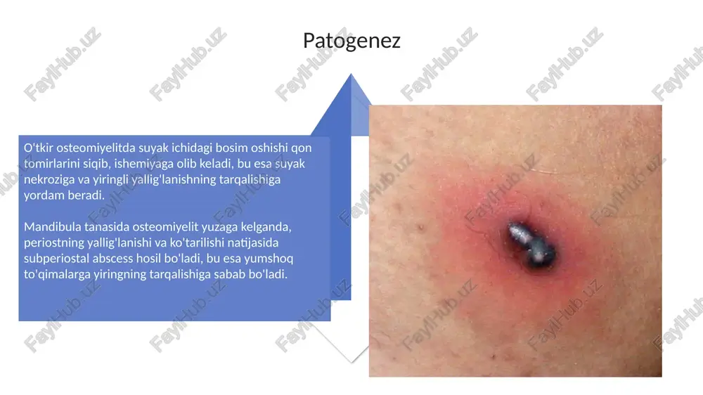 periostni ochish va drenajlash, 2-3 sm uzunlikdagi kesma bilan amalga oshiriladi, yiringni evakuatsiya qiladi va mikroblarga qarshi vositalar bilan yuviladi, bu periosteal cho'ntaklarni bartaraf etadi. e'tiboringiz uchun rahmat image5.jpg image6.jpg image7.jpg image8.jpg image9.jpg image10.jpg image11.jpg image12.jpg image13.jpg image14.jpg image15.jpg image16.jpg image17.jpg image1.jpeg image2.jpeg