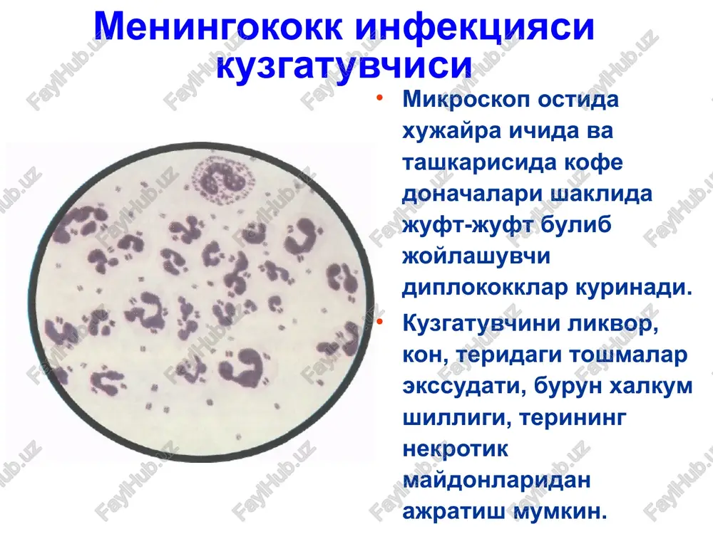 lchamlari nuktali kon kuyilishlidan to markazda joshlashgan yirik nekrozalrgacha bulishi mumkin. keyinchalik yirik zararlanish soxalarida nekrozlar kuchadi va chandiklar xosil buladi. toshmaning kayta rivojlanishi zaralanishning kengligi va xarakteriga boglik. rozeolez-papulez toshmalar 1-3 kundan sung izsiz yukoladi, chukur nekroz soxalarida uzok vakt bitmaydigan yaralar xosil buladi. 3-7 % xollarda bugimlar zaralanishi – artritlar kuzatiladi. uveitlar, xamda boshka a'zo va tizimlarning zaralanishi xam kuzatilishi mumkin. meningokoktsemiyaning klinik kurinishlari meningokoktsemiya meningokokktsemiyadagi toshmalar meningokokemiyaning ogirlik mezoni ogirlik buyicha: engil, urta ogir ogir shakli. ogirlik mezoni : toksikoz simptomning namoenligi xushning uzgarishi tana xaroratining darajasi gemorragik- nekrotik toshmaning kupligi va razmerlari meningokokkemiyaning yashinsimon kechadigan shakli - (uta utkir meningokokkli sepsis) kasallik utkir, tusatdan xarorat kutarilishi 39-40•s bilan boshlanadi, kaltirash, et uvishishi, kupgina gemorragik toshishi bilan namoenlanadi, katta kismiga kon kuyilish kuzatiladi, ab tushadi, kon aylanish etishmovchiligi, dvs, mushaklar gipotoniyasi, talvasalanish rivojlanadi. bu shakl infektsion-toksik shok deb baxolanadi. adekvat va uz vaktida davo choralari olib borilmasa …