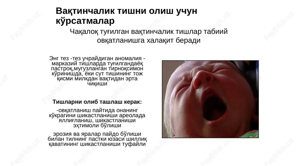 'lmagan jag'lar (ko'pincha sut qoziq tishlarida) tishlar nisbati buzilishi (mezial yoki distal okklyuziya) uchinchi molarlarni (aql tishi) va ularning chpjb ga ta'siri mezial okklyuziya moyili bor bemorlarda profilaktika uchun pastki jag o'sishi (progeniya) takrorlanishining oldini olish uchun ortodontik davolanish jarayonida pastki qismida ortognatik operatsiyaga tayyorgarlik ko'rishda ortodontik kursatmalar 24 vaqtinchalik tishni olish uchun ko'rsatmalar to'liq va qisman tish chiqishida 25 tish olishga qarshi ko'rsatmalar bolalarning ko'pchiligida tish olish uchun kasalliklar va xamroh kasalliklarini inobatga olgan holda tish olish vaqtincha qoldirilishi, bolaga tayyorgarlik ko'rilishi yoki ixtisoslashtirilgan tibbiy muassasada operatsiya qilinishi kerak. masalan, xatarli o'simta yoki arteriovenoz aloqa sohasida joylashgan tishlar 26 tish olish uchun nisbiy qarshi ko'rsatmalar o'tkir bosqichda yurak -qon tomir kasalliklari yurak faoliyatining og'ir dekompensatsiyasi buyrak kasalligi dekompensatsiyalangan funktsiyali glomerulonefrit buyrak etishmovchiligi o'tkir yuqumli va virusli kasalliklar qon kasalliklari (leykemiya, gemofiliya, trombotsitopeniya va boshqalar) markaziy asab tizimining kasalliklari (meningit, ensefalit) remissiya paytida ruhiy kasallik og'iz shilliq qavati ning o'tkir …