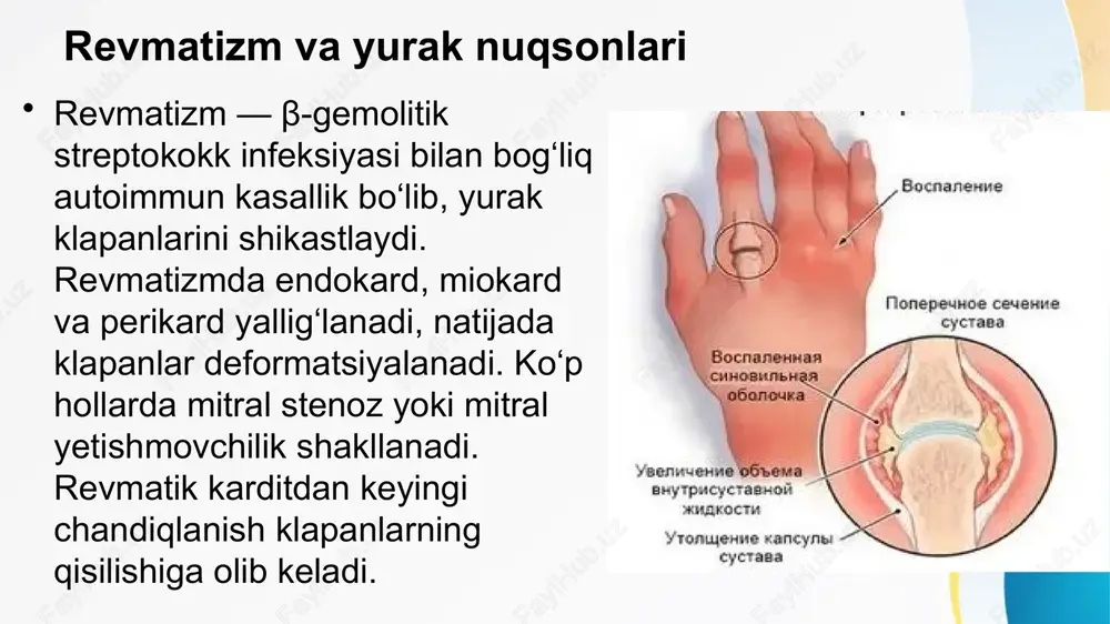 t terapiya buyuriladi. jarrohlik natijasida yurak chiqish hajmi tiklanadi, bemor hayoti sezilarli uzayadi. reabilitatsiya va parhez operatsiyadan keyin bemor yurak faoliyatini tiklash uchun reabilitatsiya bosqichidan o‘tadi. yurak yuklamasini kamaytiruvchi dietalar, past tuzli ovqatlanish, suyuqlik miqdorini nazorat qilish muhim. fizioterapiya, yengil jismoniy mashqlar, stressdan saqlanish tavsiya etiladi. hamshira va shifokor nazorati ostida bosqichma-bosqich tiklanish amalga oshiriladi. profilaktika choralar revmatizm, infeksion endokardit va aterosklerozni erta davolash yurak nuqsonlari profilaktikasining asosi. streptokokk infeksiyalarida antibiotiklar, aterosklerozda lipid pasaytiruvchi preparatlar buyuriladi. sog‘lom turmush tarzi, tuzli ovqatdan saqlanish, qon bosimini nazorat qilish, chekishni tashlash yurak kasalliklarining oldini oladi. xulosa yurak nuqsonlari — ko‘p omilli patologiya bo‘lib, revmatizm, endokardit yoki ateroskleroz natijasida rivojlanadi. vaqtida aniqlash, ekg va eko nazorati, to‘g‘ri davo va jarrohlik yondashuv bemorning umrini uzaytiradi. hamshira va shifokor o‘zaro hamkorlikda yurak nuqsonlari bilan og‘rigan bemorlarni parvarish qilishi sog‘lom tiklanishni ta’minlaydi. image1.jpeg image3.png image4.webp image5.jpeg image6.png image7.jpeg image8.png image9.jpeg image10.jpeg image11.png image12.jpeg image13.jpeg image14.jpeg image15.jpeg image16.png …