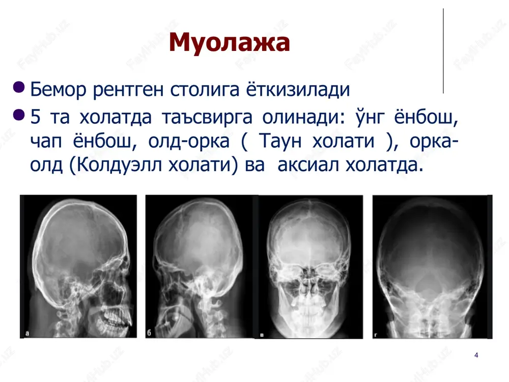 suyagi chiziqli sinishdan farqli tomonlari sinish chizig'i hamma joyda joylashishi mumkin yo'nalishi: yuqoridan kalla asosiga qarab ko'proq, kamroq gumbaz bo'ylab shakli: chiziqsimon, kamroq zigzagsimon konturlari: paralel, darz ketish oxirida birlashadi intensivligi yuqori tomir egatiga nisbatan ‹#› ‹#› kalla suyagi rentgenogrammasi – tepa suyagi sinishi ‹#› ‹#› xalkasimon shaklida sinish markazga radiar yo'nalish buyicha ‹#› kalla gumbaz suyaklarining ko'p bo'lakli sinishi ‹#› kalla gumbaz suyaklarining ko'p bo'lakli sinishi ‹#› ezilgan sinish ‹#› mielom kasalligi v-limfotsit xujayralarining mutatsiyasi natijasida yuzaga keladigan xavfli o'sma. mutatsiyaning oqibatida bir plazmatik xujayra kloning boshqarib bo'lmaydigan prolifiratsiyasiga olib keladi sinonimlari: - rustitskogo - kalera kasalligi - mieloblastoma - mieloma - mielomatoz - plazmotsitoma ‹#› rentgenologik belgilari (yassi suyaklarda) -ko'plab yumalok defektlar bir necha millimetrdan 1-2-3 smgacha. -o'choqlar chegaralangan, faqat ko'p sonli xolatlarda bir biri bilan qo'shiladi (bu xolatda xam ular xar biri aloxida chegaralangan bo'ladi.) -atrof to'qimadagi reaktiv o'zgarishlar kuzatilmaydi (osteoskleroz yoki periostit). ‹#› kalla suyagining ko'plab …