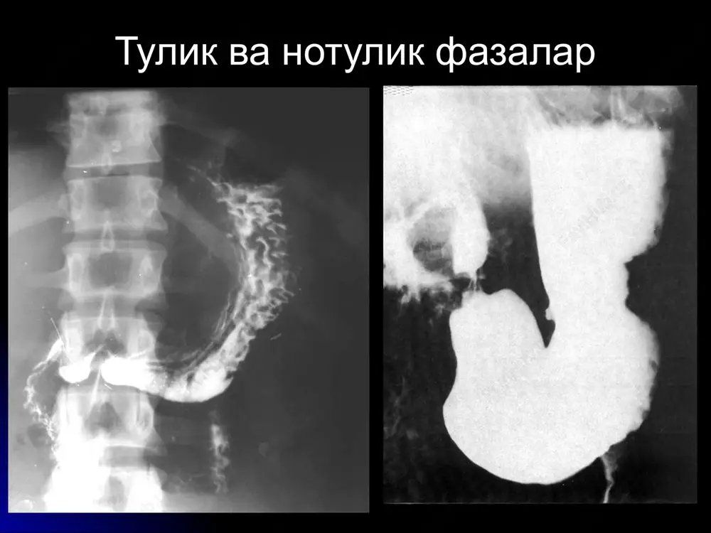 na kismida uchraydi diametri 2 sm, chegarasi notekis, yagona rentgenogrammada - tulish defekti poliplar oshkozon yarasi joylashishi – kuprok antrum, subkardiya, kichik egrilik bevosita belgilar tokcha < 2 cm (bariy dogi, deposi) yalliglanish infiltrati bilvosita belgilar peristaltika oshishi lokal spazm («kursatkich barmok» simptomi), gipersekretsiya atrof relef uzgarishi (shishi eki burmalar konvergentsiyasi) lokal ogrik yara soxasida asoratlar - 1) perforatsiya, 2) penetratsiya 3) chandikli deformatsiya 4)kon ketish 5)malignizatsiya 12-barmokli ichak yarasi oshkozon yarasiga nisbatan x2-3 baravar kuprok uchraydi kuprok erkaklarda 95% piezchada, < 1 sm kichik 85% piezcha deformatsiyalashadi malignizatsiya yuk belgilari va asoratlari oshkozon yarasidek kron kasalligi 80% och va enbosh ichakda utkir boskich - shillik kavat shishi, relef yukolishi - «bulijnaya mostovaya» simptomi, yaralar, stenoz, rigidlik surunkali boskich - chandikli torayish («shnur» simptomi) asorati - fistula, abstsess, stenoz, perforatsiya, gidronefroz, toksik megakolon, adenokartsinoma extimoli oshishi ichak tutilishi turlari 1) ingichka (80%) va yugon (20%) ichakli 2) mexanik va dinamik …