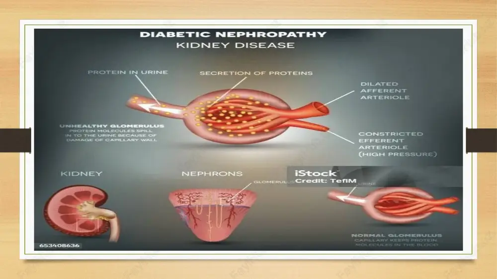 diabetiknefropatiya - Page 4