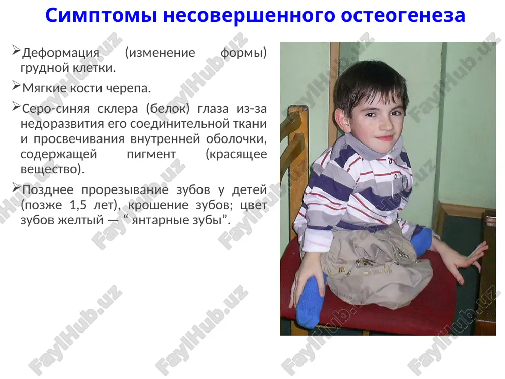 ya utrata sluxa (tugouxost). rannee vipadenie zubov. chastie pnevmonii (vospalenie legkix) iz-za deformatsii grudnoy kletki. profilaktika nesovershennogo osteogeneza nalichie bolnix v rodoslovnoy yavlyaetsya pryamim pokazaniem k mediko-geneticheskomu konsultirovaniyu. spasibo za vnimanie!
