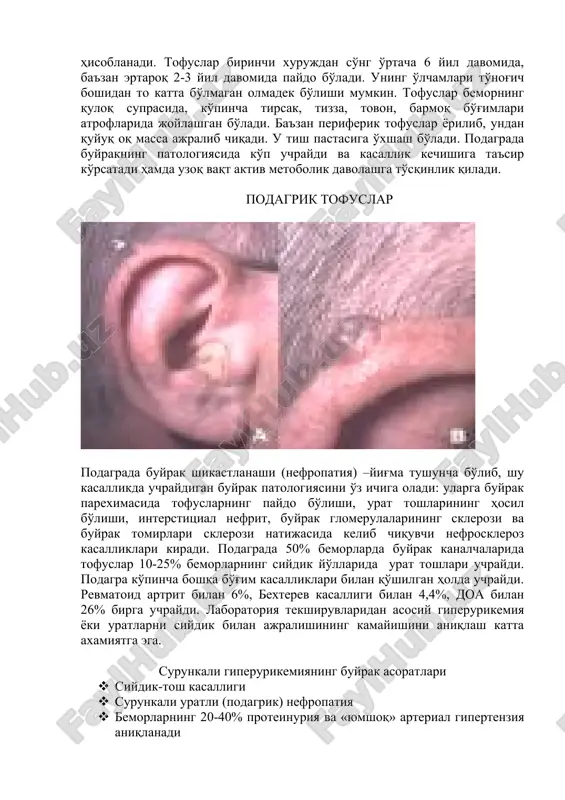 kimyoviy va polyarizatsiyali mikroskopiya usuli bilan tasdiqlangan tofuslarning aniqlanish · keltirilgan 12 simptomdan 6 tasining aniqlanishi · anamnezida bir martadan ko'p o'tkir artrit xuruji · bo'g'im yallig'lanishi kasallikning birinchi kunida maksimumga etadi · monoartrit · jaroxatlangan bo'g'im terisining giperemiyalanishi · oyoqning birinchi panja-barmoq bo'g'imida shish va og'riq · oyoq panjalarining bir tomonlama jaroxatlanishi · tofuslar borligi gumon qilinishi · giperurikemiya · oyoq bo'g'imlarining asimmetrik shishi (rentgenografiya) · eroziyalarsiz subkortikal kistalar (rentgenografiya) · sinovial suyuqlik bakteriologik tekshirilganda manfiy natija differentsial tashxis · psevdopodagra · reaktiv artrit · palindrom revmatizm · revmatoid artrit · o'tkir revmatik isitma · osteoartroz davolash: parxez bilan davolash – spirtli ichimliklar ma'n etiladi, ratsionda purin asosiga boy bulgan maxsulotlar (gusht, balik, dukkakli o'simliklar va ulardan tayyorlangan maxsulotlar mikdori kamaytiriladi. o'tkir podagra xurujini kolxitsin, pirozolon preparatlari, kortikosteroidlar bilan davolanadi. podagrani uzoq davolash uchun quyidagi preparatlar ishlatiladi: 1. yalliglanishga karshi nosteroid vositalar: voltaren (sutkasiga 150 - 200 mg), indometatsin …