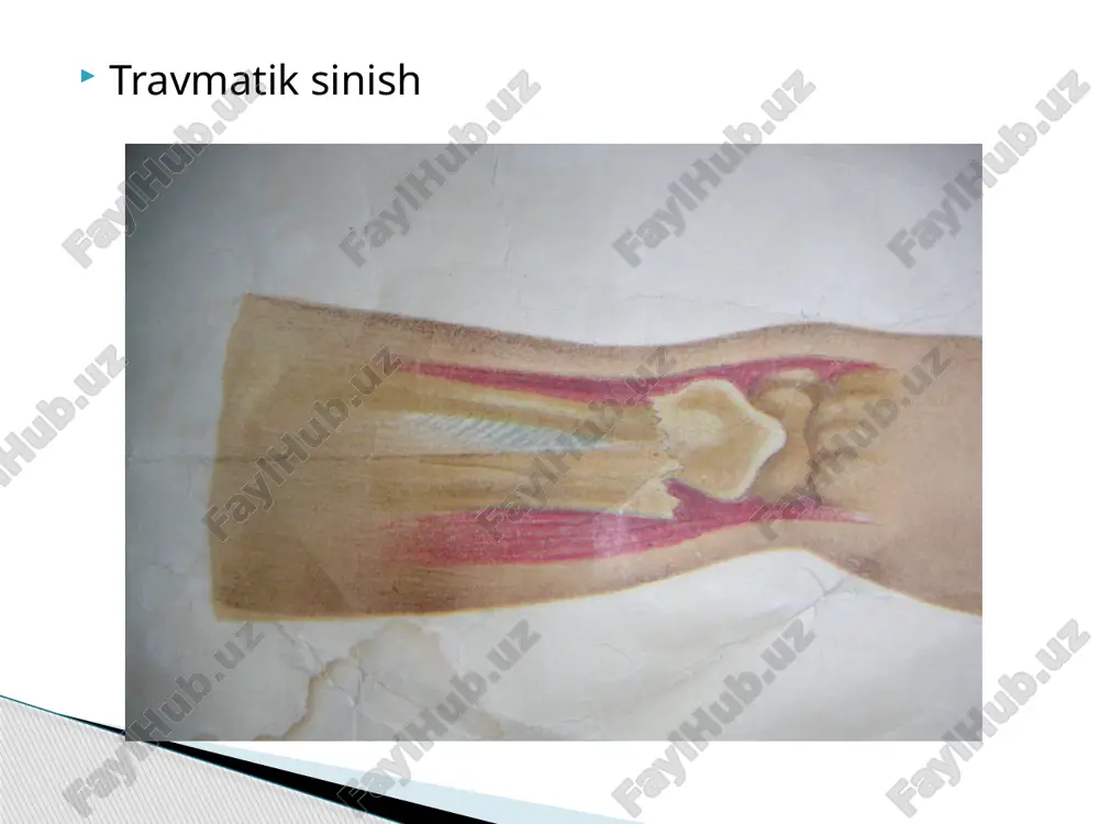 suyaklar sinishi (fractura) - Page 5