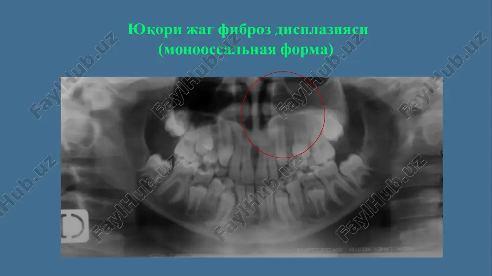 fibroz displaziya (fibrous dysplasia) - Page 5