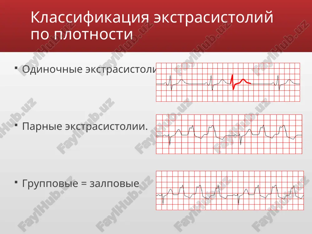 vim kompleksam (vklyuchaya ekstrasistolicheskie). diagnostika ekstrasistoli iz av-soedineniya s odnovremennim vozbujdeniem predserdiy i jeludochkov (a) i bolee rannim vozbujdeniem jeludochkov (b). diagnostika jeludochkovie ekstrasistoli voznikayut pri raspolojenii ektopicheskogo ochaga v provodyashey sisteme jeludochkov. impuls vizivaet prejdevremennoe vozbujdenie jeludochkov i ne rasprostranyaetsya na predserdiya i na sinusoviy uzel, sledovatelno ne proisxodit prejdevremennogo vozbujdeniya predserdiy i razryadki sinusovogo uzla. ocherednoy impuls v sinusovom uzle voznikaet v obichnoe vremya, on vizivaet vozbujdenie predserdiy, no ne rasprostranyaetsya na jeludochki, tak kak oni uje oxvacheni vneocherednim sokrasheniem. vozbujdenie jeludochkov proisxodit neobichnim putem, snachala vozbujdaetsya jeludochek, v kotorom naxoditsya ochag, zatem pozdnee proisxodit vozbujdenie drugogo jeludochka. ekg priznaki jeludochkovix ekstrasistol: prejdevremennoe poyavlenie na ekg izmenennogo kompleksa qrs znachitelnoe rasshirenie (do 0,12 sek. i bolshe) i deformatsiya ekstra­sistolicheskogo kompleksa qrs raspolojenie segmenta rs — t i zubtsa t ekstrasistoli diskordantno napravleniyu osnovnogo zubtsa kompleksa qrs otsutstvie pered jeludochkovoy ekstrasistoloy zubtsa r nalichie posle jeludochkovoy ekstrasistoli polnoy kompensatornoy …
