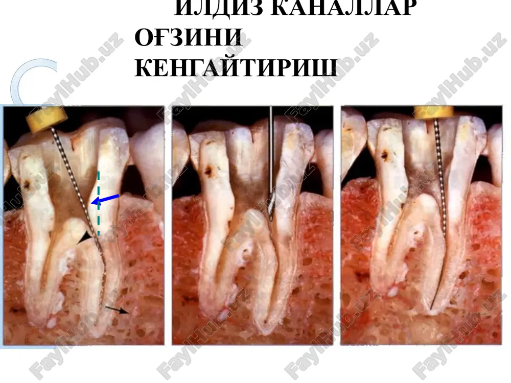 ildiz kanallariga asbob yordamida ishlov berish - Page 5