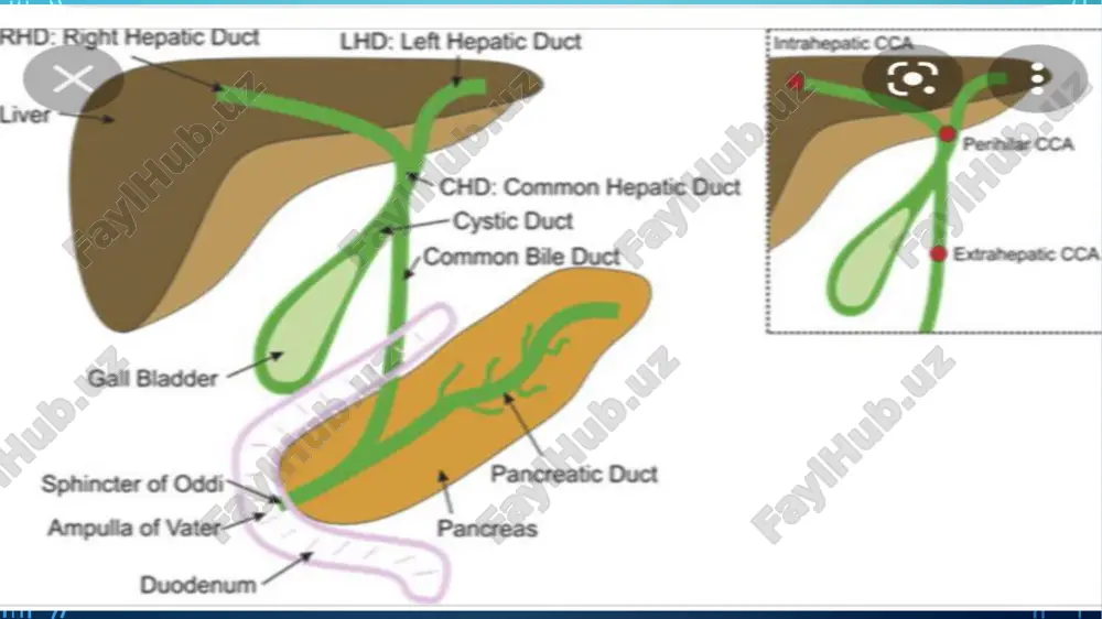biliary tract cancer - Page 5