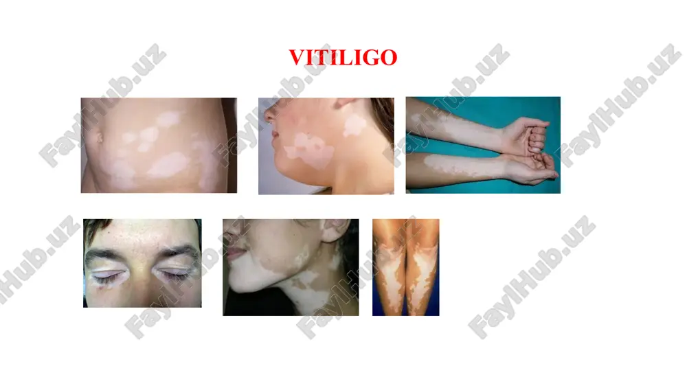 uvb broadband and narrowband lamps can be used, but narrowband ultraviolet peaked around 311 nm is the choice. * it has been constitutively reported that a combination of uvb phototherapy with other topical treatments improves re-pigmentation. however, some people with vitiligo may not see any changes to skin or re-pigmentation occurring. a serious potential side effect involves the risk of developing skin cancer, the same risk as an overexposure to natural sunlight. ultraviolet light (uva) treatments are normally carried out in a hospital clinic. psoralen and ultraviolet a light (puva) treatment involves taking a drug that increases the skin's sensitivity to ultraviolet light, then exposing the skin to high doses of uva light. treatment is required twice a week for 6–12 months or longer. because of the high doses of uva and psoralen, puva may cause side effects such as sunburn-type reactions or skin freckling. treatment narrowband ultraviolet b (nbuvb) …