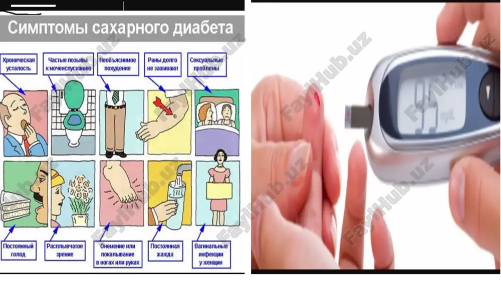 qali n+ ionning ko’p yo’qotilishi hisobidan, natriy laktatning jigarda hosil bo’lishining kuchayishida. glomerulonefrit — sabablar, davolash va oldini olish buyrak koptokchalarining o‘tkir va surunkali yallig‘lanishlari glomerulonefrit deyilib, bunda asosan buyrakdagi koptokchalar, mayda qil tomirlar zararlanadi, oqibatda buyrak faoliyati buziladi. gelomerulonefritning piyelonefritdan farqli jihatlari bor. ya’ni piyelonefritda ko‘pincha bitta buyrakning kosacha va jomchalari zararlansa, glomerulonefritda esa har ikki buyrak ham baravariga yallig‘lanadi. asosan angina, faringit, skarlatina va boshqa infeksion-yallig‘lanish kasalliklar bilan og‘rib o‘tgandan so‘ng (ba’zan esa difteriya, o‘pka yallig‘lanishi, toshmali terlama, ich terlama va shunga o‘xshash asosan streptokokklar qo‘zg‘atadigan kasalliklarga chalingandan keyin)shuningdek o‘ta sovuq ob-havo ta’sir qilganda, havoda namgarchilik ortib ketganda, zararli moddalar (alkogol, simob, qo‘rg‘oshin, atseton, benzin singarilar) organizmga ta’sir ko‘rsatganda hamda tizimli kasalliklar (qizil volchanka, gemorragik vaskulit, infeksion endokardit) bilan og‘riganda buyrak to‘qimalari zararlanishi mumkin. qovoq-atrofidagi-shishlar glomerulonefritning uchta (o‘tkir, o‘tkir osti, surunkali) turlari farqlanadi. kasallikning o‘tkir turiga chalingan bemorlarda uch xil holat (tanaga shish kelishi, arterial qon bosimi ortishi, …