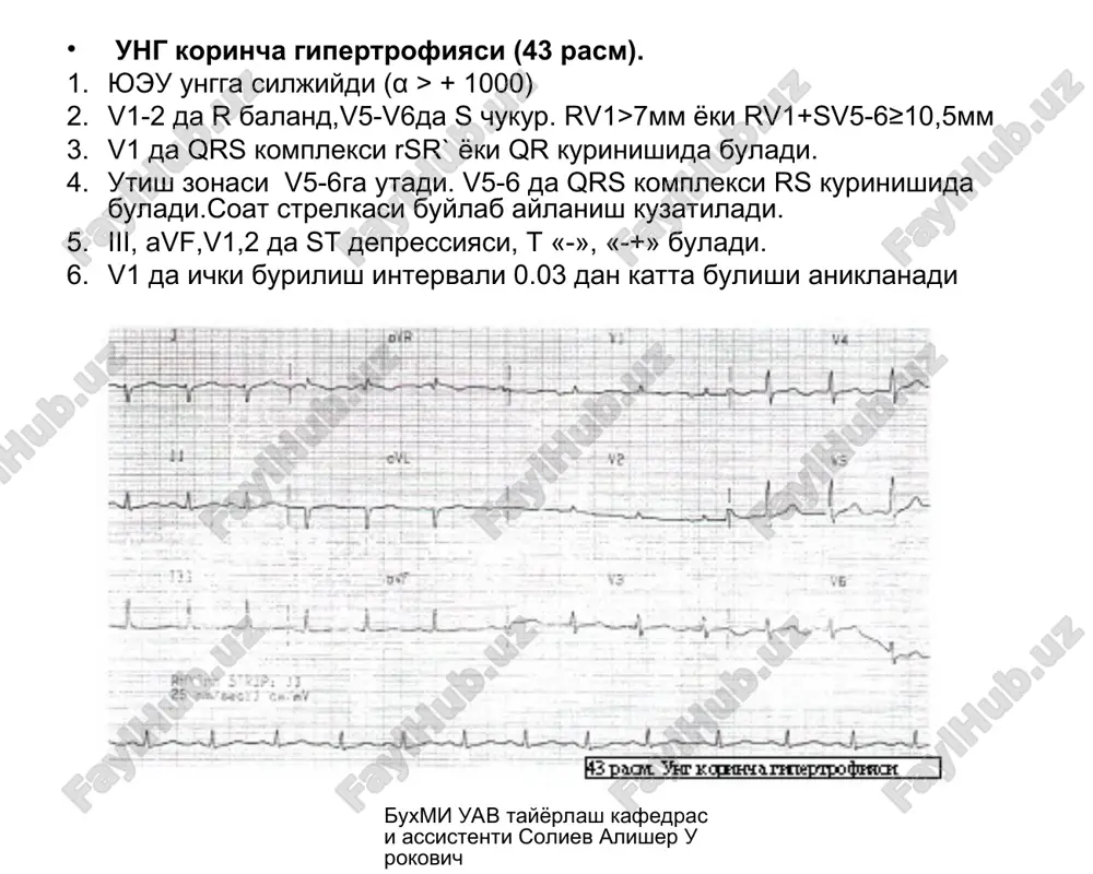 epressiyasi, xar xil ritm buzilishlari: sinusli taxikardiya, aritmiya, ekstarsistoliya, paroksizmal taxikardiya, bulmachalar titrashi va xilpillashi. ii, iii, avf da r-pulmonale. buxmi uav tayyorlash kafedrasi assistenti soliev alisher urokovich tireotoksik miokardiodistrofiyada ekg. sinusli taxikardiya, kasallikning boshlangich davrida r va t tishlarining amplitudasi baland buladi. r tishcha kengayadi va ikkilanadi, xamda xilpillovchi aritmiya rivojlanishi mumkin. st depressiyasi va t tekis, 2 fazali, manfiy bulishi mumkin. buxmi uav tayyorlash kafedrasi assistenti soliev alisher urokovich klimakterik va disgormonal miokardiodistrofiyada ekg. (55 rasm). asosan kukrak ulanishlarda t tekislangan, 2 fazali yoki manfiy buladi. kam xollarda st depressiyasi kuzatiladi. kupincha (xamma vakt emas) yukoridagi uzgarishlar kaliy va β-adrenoblokatorlar bilan sinama utkazilganda yukoladi (musbat sinama). buxmi uav tayyorlash kafedrasi assistenti soliev alisher urokovich gipokaliemiyada ekg (56 rasm). kaliy organizmga ovkat bilan kam tushganda, tinimsiz kayt kilganda, ich ketganda, siydik xaydovchi dorilardan keyingi poliuriyada, itsenko-kushing kasalligi va birlamchi aldosteronizmda, kortikosteroidlarni uzok vakt kabul kilganda, yurak glikozidlar mikdori oshirilganda …