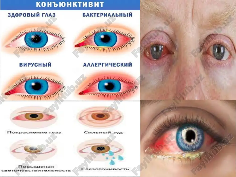 vomiyligi 5-6 kunni tashkil etadi. korneal o’zgarishlarda u uzoqroq kechishi mumkin davolash 1-1.5 oyni tashkil etadi. kasallanganlar alohida saqlanishi lozim. ajralmani tozalash uchun ko’zlarga antiseptik eritmalari tomiziladi (1:5000 - furatsilin) bir necha kun davomida har 2-4 soatda ko’zga antimikrob preparatlar tomiziladi. yallig’lanish belgilari kamayishi bilan instillyatsiyalar sutkasiga 3-5 martagacha kamaytiriladi. birinchi tanlov preparatlari sulfatsil natriyning 20% eritmasi; tobramitsin, floksalning 0,3% eritmasi yoki malxami hisoblanadi. profilaktika; 1.birlamchi; sanitar tushuntirish ishlarini olib borish. 2.ikkilamchi; bemor bilan muloqatda bulgan insonlarga antibakterial kuz tomchilarni profilaktik tomizish 2-3 mahal konyuktivitlarni davolash prinsiplari; kuzga boglam quyish man etiladi(termostat effekti),keratit rivojlanishi mumkin ajralmalarni mexanik tozalash-konyuktival bushliqni furatsillin(1;5000) antiseptik xuxusiyatli dorivor usimliklardan tayyorlangan damlamalar bilan kuz tirqishi yuvish,tozalash antibakterial kuz tomchilari levomitsetin 0,25 tsiprolet floksatsin tobrimed tobreks moksitsin oftakviks etiboringiz uchun rahmat image2.jpg image3.png image4.jfif image5.jfif image6.jfif image7.jfif image8.jpg image9.jpg image10.jpg image11.jfif image12.jfif /docprops/thumbnail.jpeg
