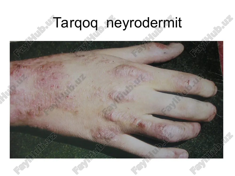 neyrodermatozlar tasnifi - Page 5
