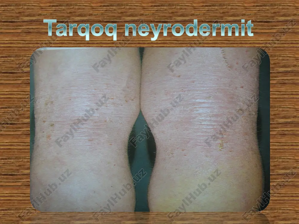 neyrodermatozlar - Page 5