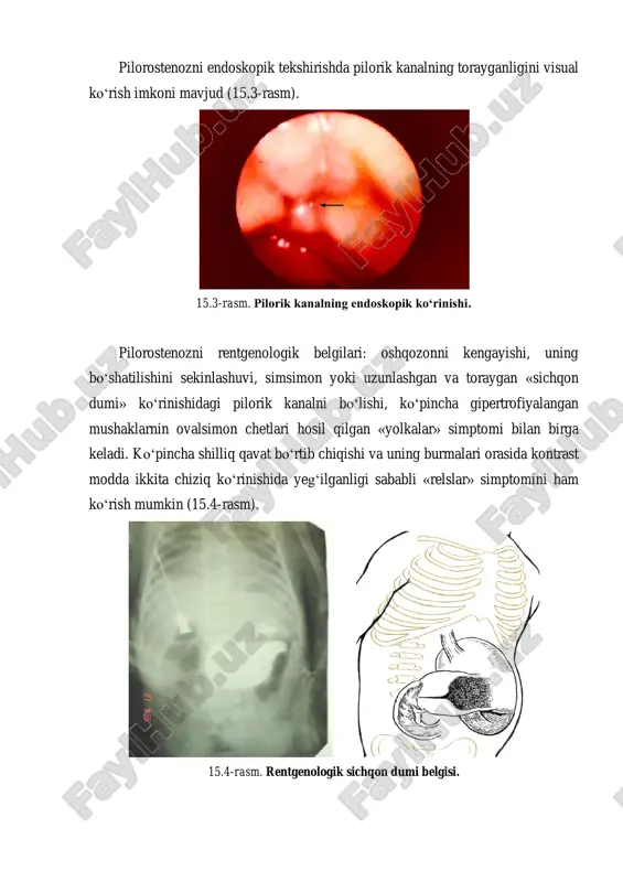 kanalni bo‘lishi, ko‘pincha gipertrofiyalangan mushaklarnin ovalsimon chetlari hosil qilgan «yolkalar» simptomi bilan birga keladi. ko‘pincha shilliq qavat bo‘rtib chiqishi va uning burmalari orasida kontrast modda ikkita chiziq ko‘rinishida yeg‘ilganligi sababli «relslar» simptomini ham ko‘rish mumkin (15.4-rasm). 15.4-rasm. rentgenologik sichqon dumi belgisi. pilorostenoz bilan og‘rigan bolalarda degidratatsiya har xil (yengildan juda og‘ir) darajada kuzatilishi mumkin va bu faqat kasallikning uzoq kechganligiga va qusishni ko‘pligiga bog‘liq. qusishda faqat oshqozon suyuqligi yo‘qolishi sababli, boshlanishda elektrolitlar kamayishi ko‘proq h+ va cl~ ionlariga, kam darajada na va k+ ionlariga bog‘liq bo‘ladi. ko‘rsatilgan elektrolit buzulishlari natijasida bolada gipoxloemiya metabolik alkaloz bilan rivojlanadi, keyinchalik k ionlarini peshob bilan yo‘qolishi bilan asoratlanadi - bu to‘qimalardan tashqari suyuqlik yuqolishiga bog‘liq oshgan na renal reabsorbsiyasini kompensatsiyasiga yo‘naltirilgan organizm reaksiyasi. alkoloz, cl ionlari kamayishi sababli, buyraklarda nariy bilan birgalikda hco3~ ionlarini absorbsiyasi oshishi natijasida kuchayadi. gipokaliemiya alkalozni chuqurlashtiradi va u, o‘z navbatida, gipokaliemiyani kuchaytiradi. shunday qilib, zararli halqa paydo bo‘ladi, uni …