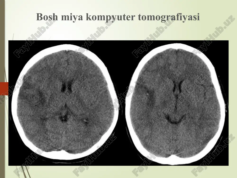 nerv-mushak kasalliklarini tashhisida ancha zamonaviy va informativ usul bo’lib, mushak va nerv tutamlari elektrik potensiali spontan tebranishlarini registratsiyasiga asoslanadi. emg tekshiruvini qo’llash birlamchi mushak, nevral, oldingi shox neyromator apparatlari zararlanishlarini kuzatishga imkon beradi. bunda yakka yoki ko’plab nevropatiyalar (mono- va polinevropatiyalar), aksonal va demiyelinlanuvchi nevropatiyalarni differensiallash imkonini beradi. orqa miya ildizlari, nerv chigallari yoki periferik nervlar zararlanishini topik tashhisini o’tkazish. tunnel sindromda nervlar kompressiyasi darajasini, hamda nerv-mushak o’tkazuvchanligi holatini aniqlaydi. ultratovush tekshiruvi ultratovush tekshiruv (utt) usuli dopler effekti (ut signalining o’zgarib harakatlanayotgan muhitdan qaytishi) ga asoslanadi. analizda struktaralardan qaytgan ut signali fiksatsiya qilinadi. bu bo’yinning yirik tomirlari (uyqu, umurtqa), miya asosining kalla ichi tomirlari, hamda yosh bolalarning bosh miyasini tasvirini olishga imkon beradi. utt ko’pincha kattalarda uyqu arteriyasistenozi va chaqaloqlarda periventrikulyar qon quyilishlarni diagnostika qilishda qo’llaniladi. transkranial doplerografiya kalla suyagi ichi tomirlarining qon aylanishini va kalibrini o’lchashda ishlatiladi. transkranial doplerografiya (tkdg) — bosh miya qon tomirlarini ultratovush tekshiruvi noinvaziv usuli …