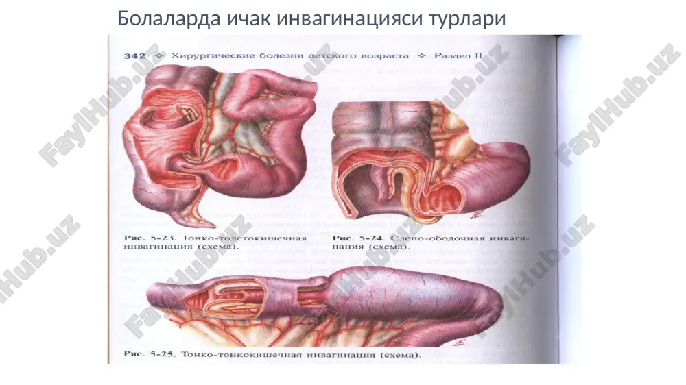 bolalarda qorinbo'shligi va paypaslanuvchi hosilasini sindromi - Page 5