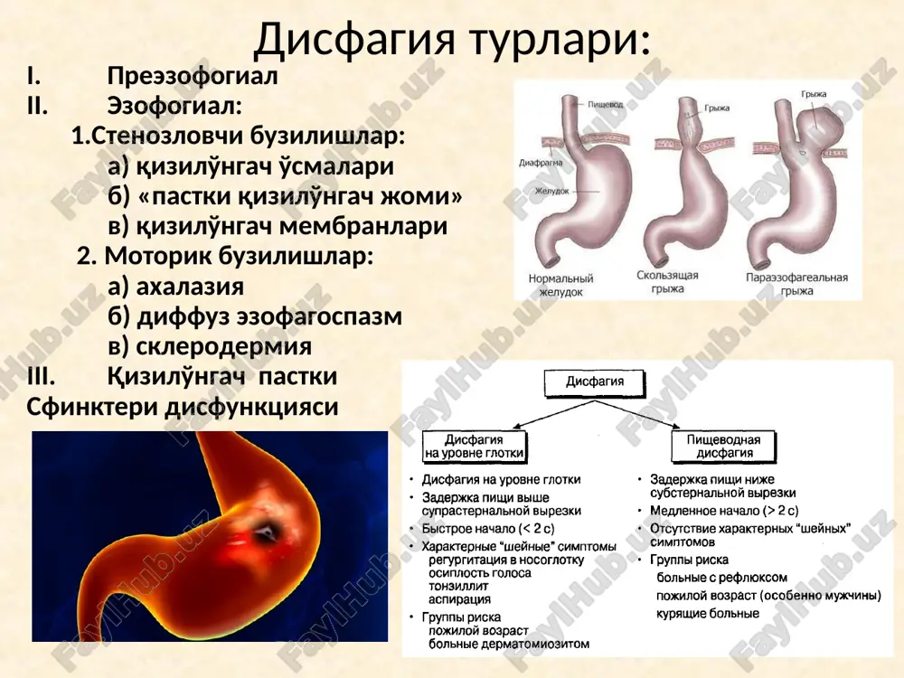 s bosimini tushiruvchi va qizilo'ngach shilliq qavatiga salbiy ta'sir etuvchi moddalar qabul qilishni kamaytirish: yog'larga boy oziq-ovqatlar (sut, qaymoq, tortlar), yog'li baliq va go'shtlar (qo'y, yog'li mol go'shti, o'rdak, g'oz), alkogol, kofe, achchiq choy, shokolad, tsitrus mevalar, tomat, piyoz, sarimsoq, qovurilga taomlar. shuningdek gazlangan ichimliklar ichishi to'xtatish - krovatning bosh tomonini ko'tarib ko'yish - qorin ichi bosimi oihshiruvchi harakatlarni cheklan: tor kiyim va kamarlar, korset kiymaslik. 8-10kg dan og'ir yuk ko'tarmaslik, qorin pressi mushaklarini zo'riqtiruvchi harakatlarini bajarmaslik; - chekishni tashlash; - tana massasini normada saqlash; - reflyuksga olib keluvchi dori vositalarini qabul qilmaslik (sedativlar, trankvilizatorlar, kaltsiy kanallari blokatorlari, a ili v adrenoblokatorlar, teofillin, prostaglandinlar, nitratlar) medikamentoz terapiya prokinetiklar, antisekretor vositalar va antatsidlarni o'z ichiga oladi prokinetiklar qizilo'ngach pastki sfinkteri funktsiyasini yaxshilaydi, oshqozon bushashini yaxshilaydi, lekin faqat kombinatson terapiya tarkibidagina foydali. domperidon (10mg 3-4 m). metoklopramid zararli ta'siri ko'proq. antisekretor terapiyadan maqsad – oshqozon kislotasining qizilo'ngachni zararlovchi ta'sirini kamaytirish. tanlov preparati …