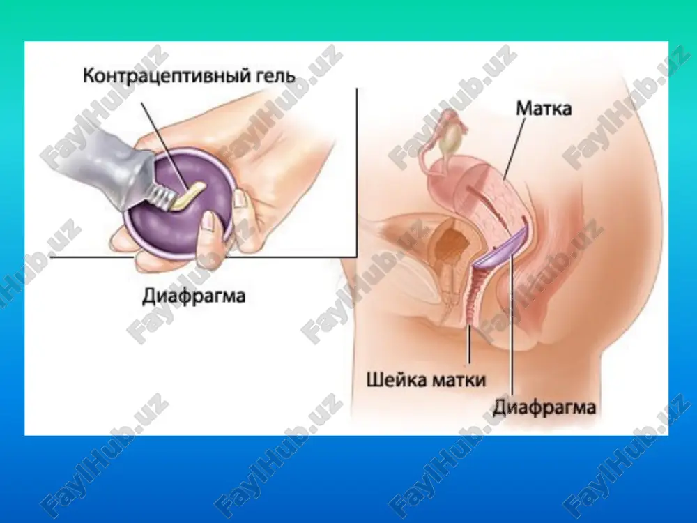 ncha turlari bor: mexanik usuli, issiqlik energiya yo'li bilan kesish. ixtiyoriy xirurgik sterilizatsiya quyidagi vaqtda qilinadi: xayz tsiklini ikkinchi yarmida, tug'ruqdan keyin 6 xafta o'tgach, ginekologik operatsiya vaqtida, abortdan keyingi sterilizatsiya, asoratlanmagan sun'iy abortdan keyin, tug'ruqdan keyin sterilizatsiya: kesar kesish vaqtida, 48 kundan keyin, tug'ruqdan 3-7 kundan keyin. qarshi ko'rsatma.mutlaq: kichik chanoqda o'tkir yallig'lanish kasalliklari,tarqalgan yoki o'choqli infektsiya, yurak qon tomir kasalliklari, aritmiya, respirator kasalliklar, diabet, qon ketishi, semizlik, kindik churrasi. hozirgi davrda bachadon naylarini laparoskop yordamida inaktivatsiya qilish, bu usul koagulyatsion usulga ko'proq yordamlashadi.erkaklar sterilizatsiyasi yoki urug' chiquvchi naylarni kesib tashlash yoki koagulyatsiya qilish.vazektomiya asoratlari. gematoma, yallig'lanish kasalliklari, epididimit. kontratseptiv effekti juda yuqori hisoblanadi etiboringiz uchun raxmat !!! image1.png image2.png image3.jpeg image4.png image5.jpeg image6.jpeg image7.jpeg image8.jpeg image9.jpeg image10.jpeg image11.png image12.png image13.jpeg image14.png image15.jpeg image16.jpeg /docprops/thumbnail.jpeg