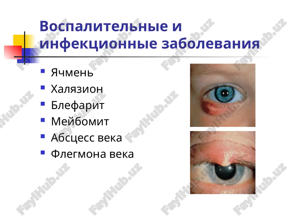 noe otsutstvie vek, glaznoy sheli i kon'yunktivalnogo meshka nablyudaetsya pri kriptoftalme ankiloblefaron vrojdennoe srashenie vek, vstrechaetsya redko kriptoftalm ankiloblefaron koloboma vek vrojdennaya koloboma vek nablyudaetsya neskolko chashe koloboma obichno bivaet na verxnem veke, chashe v ego sredney chasti, no inogda nablyudaetsya na nijnem ili na oboix vekax koloboma imeet formu treugolnika s osnovaniem u resnichnogo kraya ot malenkogo uglubleniya po krayu veka do znachitelnogo defekta vsex ego sloev neredko ot vershini kolobomi k glaznomu yabloku tyanutsya kojnie peremichki, silno ogranichivayushie ego dvijeniya koloboma vek blefarofimoz blefarofimoz - ukorochenie glaznoy sheli v gorizontalnom meridiane, obichno obuslovlennoe srastaniem kraev vek u narujnogo ugla glaza v rezultate davleniya vek na glaznoe yabloko narushaetsya krovoobrashenie v sosudax kon'yunktivi i episkleri, chto privodit k uxudsheniyu pitaniya rogovitsi rekomenduetsya rannee operativnoe lechenie blefaroxalyazis gipertrofiya koji verxnix vek, pri kotoroy ona sobiraetsya v melkie tonkie skladki i navisaet nad kraem veka eta anomaliya ustranyaetsya tolko xirurgicheskim putem …