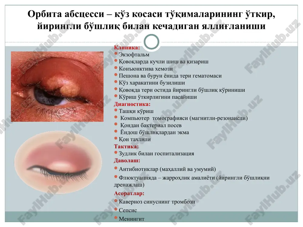 sion terapiya. flyuktuatsiya paydo bo'lsa – ochish va drenaj qo'yish. ko'z yoshi a'zolari ko'z yoshi a'zolari – ko'zni qurib qolishidan saqlaydigan yondosh apparat tizimi hisoblanib, ko'z yoshi suyuqligini ishlab chiqaradi va uni burun bo'shlig'iga chiqarib turadi. ko'z yoshi a'zolari ko'z yoshini ishlab chiqaruvchi (ko'z yoshini sekretsiyalovchi) va ko'z yoshini oqizuvchi ikkita bo'limga bo'linadi. ko'z yoshi ishlab chiqarish apparati asosiy ko'z yoshi bezidan va kon'yunktival bo'shliqda joylashgan bir nechta qo'shimcha bezchalardan iborat (krauze bezchalari). ko'z yoshi yo'llariga: ko'z yoshi nuqtalari, ko'z yoshi ko'li, ko'z yoshi kanalchalari, ko'z yoshi qopi va ko'z yoshi-burun kanali kiradi. o'tkir dakrioadenit etiologiyasi: patologiya kamdan-kam hollarda o'z-o'zidan paydo bo'ladi, asosan, jarayon asosiy kasallikka (revmatizm, gripp, tonzillit, tepki, zahm, sil, autoimmun kasalliklar, qon kasalliklari, immuntanqislik) javob sifatida rivojlanadi, bu esa ikkilamchi kasallikning rivojlanishidagi asorat bilan bog'liq, bu kam uchraydigan holat. jarayon ko'pincha bir tomonlama bo'ladi. tasnifi: dakrioadenit o'tkir, o'tkir osti va surunkali, bir tomonlama va ikki tomonlama bo'lishi …