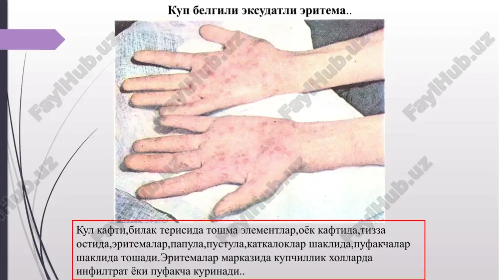 lashishi seziladi. tashqi ko’rinishda va labarator tekshiruvda kuzatiladi yarali turidan tashhari qalbaki shilliq qobiq sili yoki vensan anginasini boqmali turi kuzatiladi. jarayon ko’pincha bodomchasimon bezda kuzatilib, sarg’ish ko`k qoplam hosil qiladi. yallig’lanish belgilari atrof to’qimaga umuman tarqalmagan bo’ladi. qoplam olib tashlangandan keyin sekinlik bilan epitilizatsiyalanuvchi granulyatsiya qoladi. vensanning qoplam shaklidagi anginasi yarali shakliga nisbatan kam uchraydi. kasallik boshlangandan 2-3 hafta o’tgach, sekinlik bilan chekina boshlaydi. kamdan-kam holatlarda, xastalik davolanmasa, surunkali ko’rinishda kechadi, uzoq vaqt yiringli nekrotik jarayon milk chetlari bo’ylab davom etib, keyin birlamchi yara epitelizatsiyalanadi. vensan anginasiga tashxis kasallikning klinik ko’rinishi va simbioz fuzospirallari topilishi asosida qo’yiladi. vensan anginasining farqli tashxisi (difteriya) bilan qilinadi. shuni esda tutish zarurki, difteriyali aralashma ogir belgilarni namoyon qiladi, jarayon simmetrik tavsifda kuzatiladi, difteriya yallig’lanish qoplamasi asosi ustiga mustahkam o`rnashgan bo`ladi. vensan anginasi qon kasalliklaridagi (leykoz, agranulotsitoz) eroziya-yarali yallig’lanishlardan farqli tashxislanadi. qiyosiy tashxisi: birinchi navbatda benzilpentsillinning 300000-500000 ed dan kuniga 4 marta 3-5 kun …