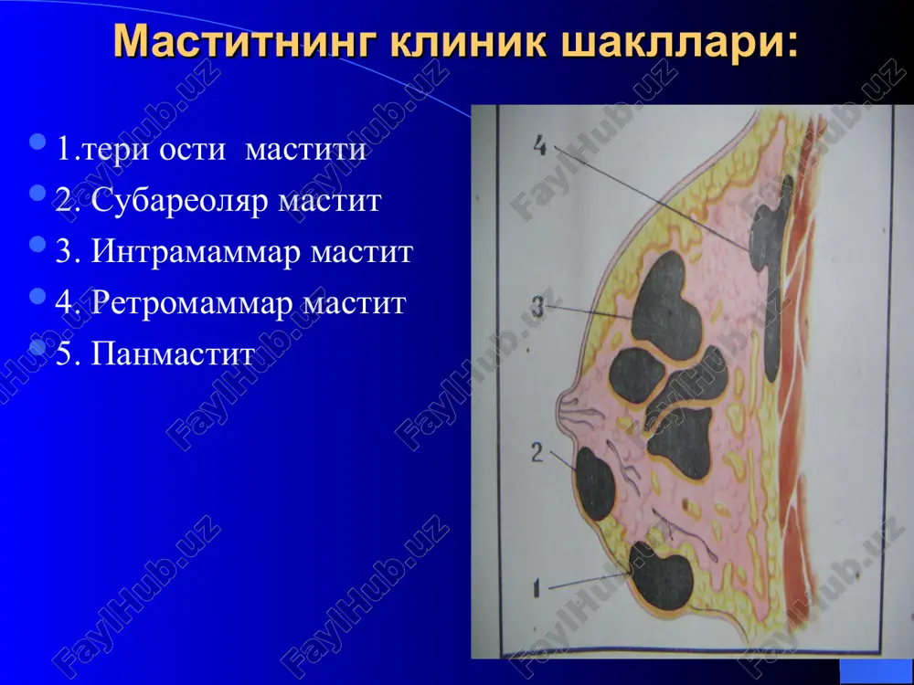 bugim panaritsiysining klinikasi: doimiy ogriklar barmokning urchiksimon (veretenoobraznaya) shaklga kirishi teri giperemiyasi barmokda odatiy bulmagan xarakatlar paydo bulishi krepitatsiya suyak-bugim panaritsiysida barmokning kurinishi bugim panaritsiysini davolash ikkita parallel kesim bilan artrotomiya kilish. falangalararo bugimni rezektsiya kilish. kechikkan, ogir xolatlarda esa barmokni amputatsiya kilish. suyak-bugim panaritsiyasida falangalararo bugimni rezektsiya kilish pay panaritsiysi panaritsiyning bu turi uzok vakt davomida barmoklar faoliyatini buzilshiga olib keluvchi ogir turi bulib, u pay kinlariga mikroblarning bevosita tushishi natijasida yoki yuzaki panaritsiylarda yalliglanish jarayonining chukurga davom etishi natijasida rivojlanadigan yiringli yalliglanish jarayonidir pay panaritsiysining klinikasi barmokning shishishi barmokning bukilib kolishi faol xarakatlarning cheklanganligi xarakat vaktida ayniksa barmokni yozish vaktida keskin ogriklar paydo bulishi umumiy xolsizlik bosh ogrishi tana xaroratining kutarilishi pay panaritsiysida barmokning kurinishi: pay panaritsiysini davolash pay panaritsiysini operatsiya kilishda barmok asosiy falangasining old-yon yuzalaridan ikkita parallel va pay kinlarini ochish uchun kaftda bitta kesim kilish etarli buladi. bushlikka rezina pilikchalar urnatiladi, kaft va barmoklarga gipsli …