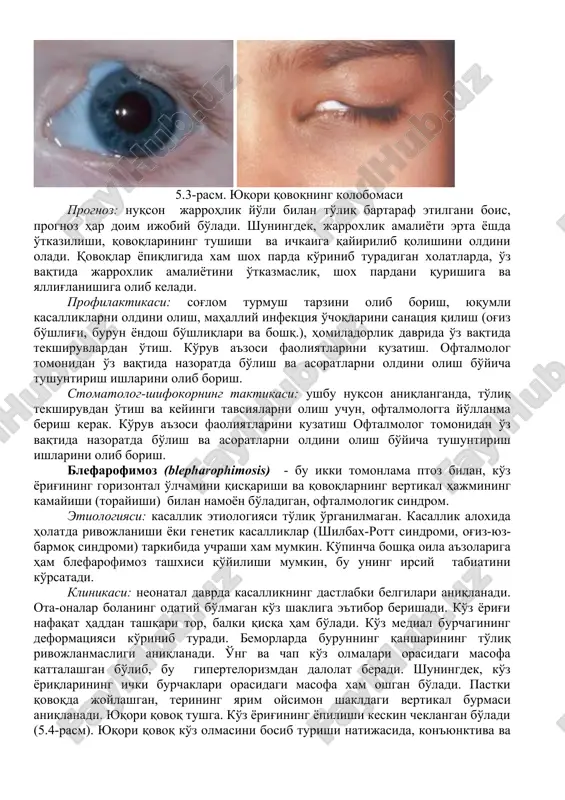 tlarni oldini olish bo'yicha tushuntirish ishlarini olib borish. stomatolog-shifokorning taktikasi: ushbu nuqson aniqlanganda, to'liq tekshiruvdan o'tish va keyingi tavsiyalarni olish uchun, oftalmologga yo'llanma berish kerak. ko'ruv a'zosi faoliyatlarini kuzatish oftalmolog tomonidan o'z vaqtida nazoratda bo'lish va asoratlarni oldini olish bo'yicha tushuntirish ishlarini olib borish. qovoqning tug'ma kolobomasi (soloboma) - qovoq qirrasi nuqson. etiologiyasi: embrional davrda, ko'zning rivojlanishida, zararlovchi omillarning ta'sir qilishi natijasida rivojlanadi. buning natijasida, ko'z qadahining embrional tirqishini noto'g'ri yopilish yuz beradi va paydo bo'layotgan tuzilmalar shakli buziladi. klinikasi: tekshiruv paytida qovoq qirrasi nuqsoni aniqlanadi, u turli xil o'lchamda, uchburchak yoki yarim doira shaklida bo'lishi mumkin, qovoqning barcha qavatlarini qamrab oladi va ko'pincha yuqori qovoqda uchraydi. u bir va ikki tomonlama bo'lishi mumkin. shu tufayli, bemor qovoqning kosmetik nuqsonidan shikoyat qiladi (5.3-rasm). diagnostika: ko'ruv a'zosidagi boshqa nuqson yoki o'zgarishlarni aniqlash uchun, kompleks oftalmologik tekshiruv (viziometriya, biomikroskopiya, tonometriya, ko'zning ultratovush tekshiruvi, oftalmoskopiya va boshq.) o'tkazish lozim bo'ladi. davolash: davolashdan maqsad, …