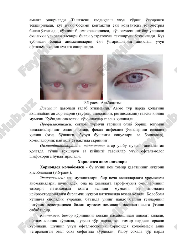 qon tomir qavatining nuqsoni hisoblanadi (9.6-rasm). etiologiyasi: gen mutatsiyalari, bir necha avlodlardagi xromosoma anomaliyalari, shuningdek, ona va homilaga atrof-muhit omillarining ta'siri natijasida yuzaga kelishi mumkin. bu anomaliya neyroektodermadagi birlamchi nuqson natijasida yuzaga keladi. koloboma ko'pincha sporadik uchraydi, ba'zida uning paydo bo'lish genlarning noto'liq penetratsiyasi bilan autosom-dominant nasldan-naslga o'tishi sabablidir. klinikasi: bemor ko'rishning keskin pasayishidan shikoyat qiladi, oftalmoskopik ko'rikda, nuqson to'r parda, qon-tomir pardasi orqali ko'rinadi, shuning uchun oftalmoskopik xorioideya kolobomasi aniq chegaralangan oval soha sifatida ko'rinadi. ushbu sohada to'r parda etarlicha rivojlanmagan yoki umuman yo'q. mutloq skotomaning mavjudligi-bu anomaliyaning xarakterli belgisidir. koloboma chegaralangan bo'lishi mumkin, ba'zida u mikrofalm bilan birga keladi yoki pato sindromining belgilaridan biri hisoblanadi (13- xromosomaning trisomiyasi). 9.6-rasm. xorioideya kolobomasi xorioideyaning tug'ma anomaliyalariga bundan tashqari, brux membranasida va xorioderemiyada druzning hosil bo'lishi- aynan qon-tomir qavatining nuqsoni bo'lib, tungi ko'rlik va markaziy ko'ruv o'tkirligini pasayishi bilan kechadigan holatlar kiradi. diagnostikasi: tashxis keng qamrovli oftalmologik tekshiruv natijalari asosida qo'yiladi. …
