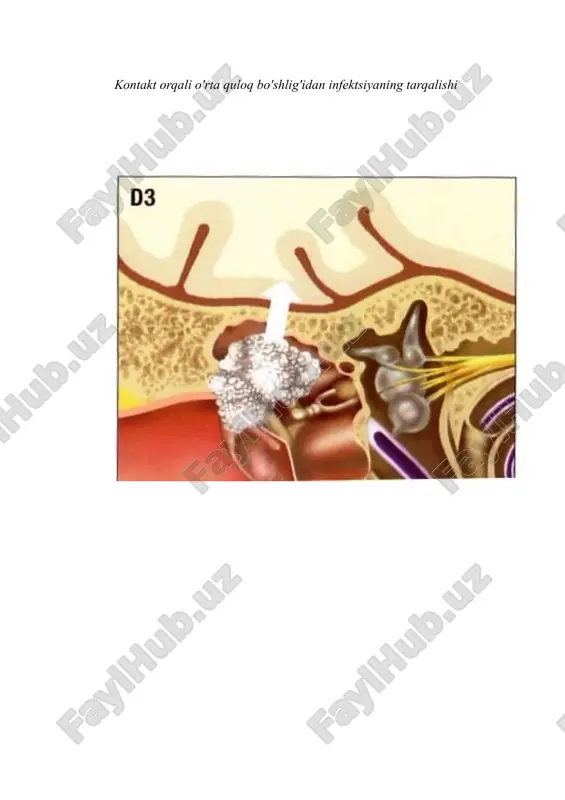 ning shishishi - ongning buzilishi bo'lishi mumkin - yengil letargiyadan chuqur komagacha. oto- va rinogen intrakranial asoratlar klinikasi. i̇ntrakranial asoratlarning chastotasi va ulardan o'limga olib keladigan statistik ma'lumotlar juda ziddiyatli. quloqlarning yallig'lanish kasalliklari bilan og'rigan bemorlarning umumiy sonidan intrakranial asoratlari bo'lgan bemorlar, turli mualliflarning fikriga ko'ra, 1,6% dan 7,9% gacha. keksa odamlarda ular yosh va yetuk odamlarga qaraganda 3,9 marta tez-tez uchraydi. kontakt orqali o'rta quloq bo'shlig'idan infektsiyaning tarqalishi sinustromboz (sepsis, sigmasimon sinus trombozi). tromboflebitis sinus sigmoidei - mikroblar ta'sirida sigmasimon sinus devorining buzilishi va unda tromb hosil bo'lishi natijasida yuzaga keladi, tromb va sinusning yiringli yallig'lanishi rivojlanadi; otogen sepsis o'tkir va surunkali otitning asoratlari sifatida sigmasimon sinusning trombozi natijasida rivojlanadi. ikkinchisi jarayonning kontakt orqali tarqalishi natijasida rivojlanadi. dastlab, sinusning tashqi devoridagi yallig'lanish jarayoniga ulangan temporal suyakda periflebit rivojlanadi va sinus atrofida xo'ppoz paydo bo'ladi. sigmasimon sinusda klapanlar yo'qligi va qon bosimining pastligi tufayli sinusda tromb hosil bo'ladi. asta-sekin yiringli …