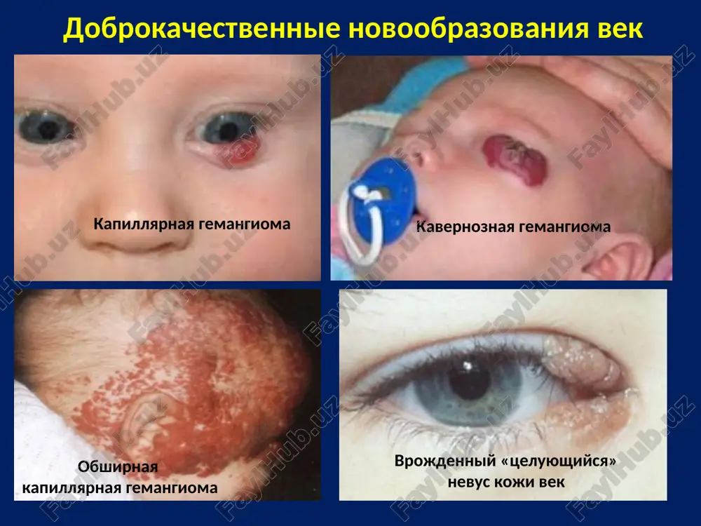 tsiy ili poteri oboix alleley rb-gena, deletsiya uchastka v 13ql4 xromosome (6-10 %). rasprostrannenost 1 na 15000 jivix novorojdyonnix. chashe diagnostiruyut v vozra­ste 18 mes. zavisimosti zabolevae­mosti ot rasi i pola ne viyavle­no. v srednem v 60% sluchaev opuxol odnostoronnyaya – viyavlyaetsya v vozraste 2 let - nenasledstven­nie v 40% - dvustoron­nyaya opuxol viyavlyaetsya v vozraste 1 goda - nasledstvennie i prakticheski vsegda multifokalnie. peredaetsya po nasledstvu, chashe po dominantnomu tipu. 90—95 % sluchaev retinoblastomi diagnostiruyutsya u detey do 5 let *retinoblastoma., saakyan s.v., 2005g. klassifikatsiya retinoblastomi. (t (tumor), n (nodule), m (methastases) voz v 1982 g) to — pervichnaya opuxol ne viyavlena. t1 — opuxol zanimaet menee ch ploshadi setchatki. t2 — opuxol zanimaet 'v-l/i ploshadi setchatki. tz — opuxol zanimaet bolee ploshadi setchatki, vixodit za ee predeli, no v polosti glaza. tza — opuxol zanimaet bolee 1/2 ploshadi setchatki i/ili imeyutsya kloni opuxolevix kletok v steklovidnom tele. tzb …