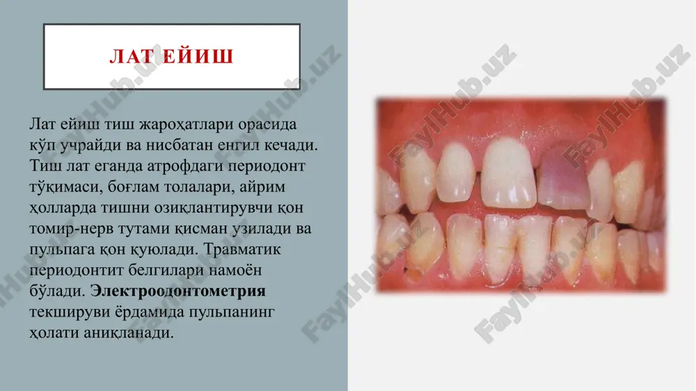 izig'i bo'ylab milkning yirtilgan yarasini ko'rish mumkin. paypaslanganda, singan bo'lak qimirlaydi. barmoqni bo'lakka qo'yib, ehtiyotkorlik bilan qimirlatib, sinish chizig'ini aniqlash mumkin. siniq bo'lak va sinish chizig'ida joylashgan tishlar perkussiyasi og'riqli bo'ladi. davolash: mahalliy infiltratsion va o'tkazuvchan og'riqsizlantirish ostida singan bo'lak repozitsiya qilinib, uning sinishidan avval bo'lgan o'rnida ekanligiga tishlam bo'yicha ishonch hosil qilinadi. immobilizatsiya tekis skoba shinasi bilan amalga oshiriladi. e'tiboringiz uchun raxmat. image1.jpeg image2.jpeg image3.jpeg image4.jpeg image5.png image6.jpeg image7.jpeg image8.jpeg image9.jpeg image10.jpeg image11.jpeg image12.jpeg image13.png image14.png tooth anatomy cheek tooth dental infographics /docprops/thumbnail.jpeg