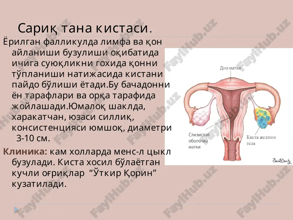 sh kuzatiladi. refeminizatsiya keksa ayollarda kuzatilib,vulva va qin epiteliysi tushganligi va bachadon kattalashganligi kuzatiladi.gistolagik tekshiruvlarda endometriy giperplaziyasi ko'ringadi.davolashda operativ muolaja bo'lib, keksa yoo'li ayollarda pangistroektomiya. - teka xujayralar o'smasi(tekoma). 2.maskulinizatsiyalovchi (erkaklashtiruvchi) o'smalar -androblastomalar. arrenoblastoma xujayralar faol testosteronni ajratib, defeminizatsiyani (sut bezlari kichrayishi, amenoreya) va maskulinizatsiyani keltirib chiqaradi. ( ovoz do'rillashishi, klitor kattalashishi). arrenoblastoma bir tomonlama bo'ladi. tashxislashda tashqi ko'rinishga qarab va siydikdagi ketosteronlar miqdoriga qarab aniqlash mumkun. disgerminoma- embrionogenezda na ayol va na erkak xujayrasi shakliga kirmay qolgan xujayralar paydo bo'ladi. navqironlik paytidan 30 yoshgacha aniqlaniladi. xamisha xavfli o'sma xisoblangan. tekshirish: anamnez yeg'ish, bimanual tekshirish. qin orqali, rektal tekshirish axamiyatli. uzi, rkt o'sma aniqlashda katta axamiyatga ega. davolash: birinchi operatsiya keyin esa rentgen tushurib davo qilinadi. ximyaterapiya va gormonal terapiya (tiotef, sarkolizin, testosteron) tuxumdon kistomalarini bachadon o'smalaridan farqli taraflari: 1.o'sma konsistensiyasi elastik 2.yuzasi tekkis va silliq 3.xarakatchanligi 4.oddiy seroz kistomalarning sharsimon shakldaligi. tuxumdon o'smalarining xavfli ekanligini ko'rsatuvchi belgilar: maxalliy belgilar: …
