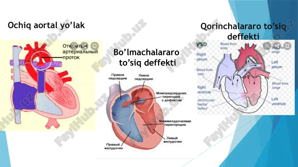 aliyotlari palliativ va radikal bo‘lishi mumkin. palliativ jarrohlik amaliyotlari aorta bilan o‘pka arteriya­si o‘rtasida tutashma (yo‘l) xosil qilinib, kuchsiz arterilizatsiyalangan qonning aortadan o‘pka arteriyasiga, toraygan qismini chetlab o‘tib, tushishi ta'minlanadi. eng ko‘p tarqalgan amaliyotlarga blelok-tausig jarrohlik amaliyoti kiradi. bunda o‘ng o‘mrov osti arteriyasi va o‘pka arteriyasini o‘ng tarmog‘i orasida anastomoz qo‘yiladi. odatda, radikal operatsiyadan oldin birinchi bosqichda palliativ usul qo‘llaniladi. aortal stenoz aorta «og‘zi» stenozi qonni chap qorinchadan katta qon aylanish doirasiga o‘tishiga to‘sqinlik qilib, uning ortiqcha ishlashiga, gipertrofiyaga uchrashiga, keyin esa dilatatsiyasiga va chap qorincha yetishmovchiligining rivojlanishiga olib keladi. gemodinamikadagi buzilishlar birinchi navbatda koronar va serebral qon aylanishi buzilishida namoyon bo‘ladi klapan klapan usti turlari klapan osti nafas qisishi, tezda charchab qolish, yurak astmasi xurujlari, stenokardiyaga xos og‘riqlar, bosh aylanishi, xushdan ketish kuzatiladi. 1.norma 2.aortal stenoz angiokardiografiya torayish joyi va o‘lchamlarini aniq belgilash, chap qorincha bilan aorta o‘rtasidagi bosim gradientini aniqlashga imkon beradi. davolash - faqat jarrohlik usuli, simob …