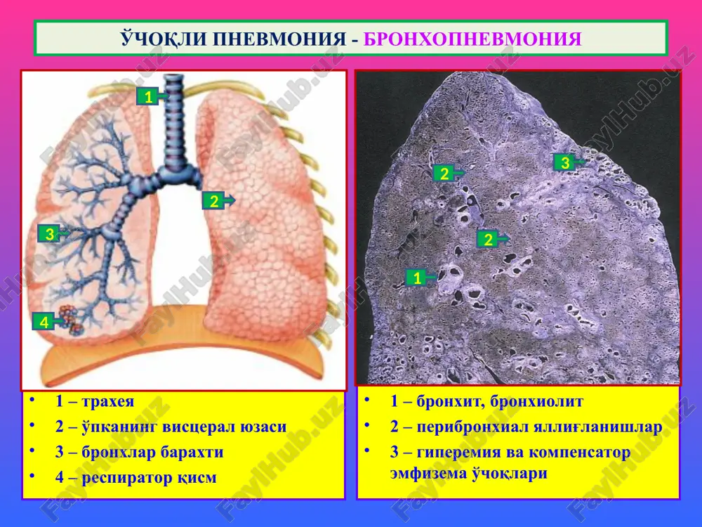 lishi, deformatsiyalanib, o'lchamlarining kattalashishi. turlari: 1) surunkali diffuz obstruktiv; 2) surunkali o'choqli, 3) kompensator, 4) birlamchi idiopatik, 5) qarilik, 6)interstitsial. makro-: o'pka keskin kattalashgan, xavo bilan to'lib, shishirgan ko'rinishda, oqargan, yumshagan, g'irchillab kesiladi. mikro-: o'pkaning respirator qismi atsinuslari kengayib, devori yupqalashgan, alveola yo'llari kengaygan. alveolalar devori yupqalashgan, taranglashgan, tomirlari torayib sklerozlangan. emfizema uzoq vaqt davom etishida kichik qon aylanish doirasida gipertenziya rivojlanib, o'ng qorinchaga yuk tushadi va gipertrofiyalanib “o'pka yuragiga” aylanadi. 1-o'choqli obstruktiv emfizema 2-o'choqli bulez emfizema 1-emfizematoz alveolalar 2-yorilgan alveolalar aro devor 3-antrakoz emfizema 1 2 o'snk va “o'pka yuragi” rivojlanish mexanizmi