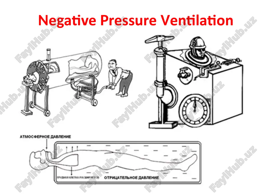 me srar: davlenie v dixatelnix putyax (peep) 5-8 sm vod. st. rejim bilevel positive airway pressure (bipap) preimushestva rejima. respiratornaya podderjka v rejime bipap pozvolyaet reshit prakticheski te je klinicheskie zadachi, chto i srar: • obespechit vozdushnost alveol za schet povisheniya ostatochnoy emkosti legkix i preduprejdeniya prejdevremennogo ekspiratornogo zakritiya dixatelnix putey; • podderjat proxodimost verxnix otdelov dixatelnix putey pri provedenii neinvazivnoy ventilyatsii cherez masku ili spetsialniy shlem. rejim bilevel positive airway pressure (bipap) nedostatki rejima. pri ustalosti dixatelnoy muskulaturi i v drugix sluchayax ugneteniya samostoyatelnogo dixaniya mogut razvivatsya gipoksiya i giperkapniya. pokazaniya k ispolzovaniyu rejima bipap - respiratornaya podderjka u bolnix s sindromom obstruktivnogo sonnogo apnoe, neinvazivnaya ventilyatsiya pri serdechnoy astme i kratkovremennaya ivl v neoslojnennom posleoperatsionnom periode. standartnie ustanovki respiratora. nijnee davlenie (peep) 5-8 sm vod. st., verxnee davlenie 12- 15 sm vod. st. dvoynie rejimi rejim pressure regulated volume control (prvc) nalichie dvoynix rejimov predstavlyaet soboy popitku sovmestit …