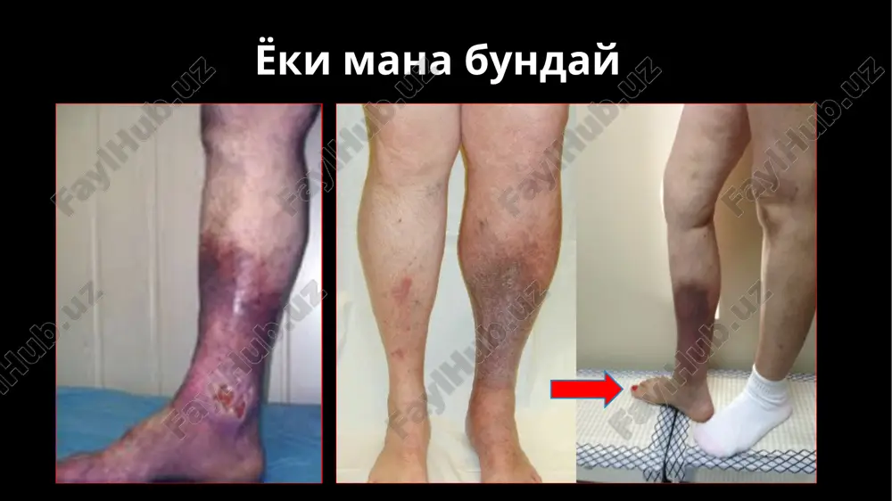 llarov v god, a v ssha – bolee 1 milliarda dollarov ejegodno. * uzbekiston 0,3-1,0% - 100 000 - 300 000 inson 4-5 mln. sum 300 000 - invalid chislennost naseleniya respubliki uzbekistan an segodnyashniy den sostavlyaet primerno 30 millionov. 0,3-1% iz 30mil eto- 100000-300000 lyudey imeyut xvn v stadii troficheskix izmeneniy. mi priblizitelno podschitali zatrati u svoix bolnix i viyasnili chto kajdiy patsient sam tratit primerno v god 2,5-3 milliona sumov dlya lecheniya svoego zabolevaniya. xvn vizivaet ne tolko ekonomicheskie problemi ona vizivaet bolshie sotsialnie problemi to est primerno 300000 lyudey yavlyayutsya invalidami, teryaetsya kachestvo jizni etix bolnix * 1. vertikal reflyuksni bartaraf etish operatsiyasi 2. gorizontal venoz reflyuksni bartaraf etish operatsiyalari 3. chukur venalarda reflyuksni bartaraf etish operatsiyalari klapanlar intravazal korrektsiyasi: sun'iy klapanlar: klapanlar transplantatsiyasi 4. aynalma yullar xosil kilish operatsiyalari linton operatsiyasi mnogoletniy mejdunarodniy opit primeneniya operatsii lintona i ee modifikatsiy, s odnoy storoni, podtverdil visokuyu effektivnost …