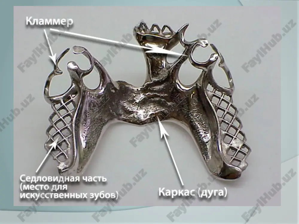 v. funktsionalnoe sootnoshenie antagoniruyushix grupp zubov. funktsionalnoe sootnoshenie zubnix ryadov verxney i nijney chelyusti. vid prikusa. funktsionalnoe sostoyanie slizistoy obolochki bezzubix uchastkov alveolyarnix otrostkov (tolshina, stepen podatlivosti slizistoy obolochki, porog bolevoy chuvstvitelnosti). formu i razmer bezzubix uchastkov alveolyarnix otrostkov. vidi funktsionalnogo sootnosheniya zubnix ryadov. ottiski i modeli: pri defektax zubnix ryadov, ogranichennix distalnoy oporoy, mojno oboytis anatomicheskimi ottiskami pri defektax bez distalnoy opori neobxodimo snimat funktsionalnie ottiski individualnimi lojkami dlya polucheniya tochnogo otpechatka bezzuboy oblasti, osobenno distalnogo uchastka. dlya izgotovleniya odnogo byugelnogo proteza neobxodimo poluchit dva rabochix ottiska i odin vspomogatelniy, sootvetstvenno, na sleduyushem etape neobxodimo po etim ottiskam otlit dve rabochie gipsovie modeli i odnu vspomogatelnuyu. po vspomogatelnomu i pervomu rabochemu ottiskam otlivayut dalee gipsovie modeli sootvetstvenno, oni neobxodimi dlya fiksatsii modeley v polojenii tsentralnoy okklyuzii, postanovki iskusstvennix zubov i polimerizatsii plastmassi. (2) 1-iy laboratorniy etap izgotovlenie diagnosticheskix modeley, izuchenie ix v parallelometre izgotovlenie voskovix shablonov i prikusnix (okklyuzionnix) …
