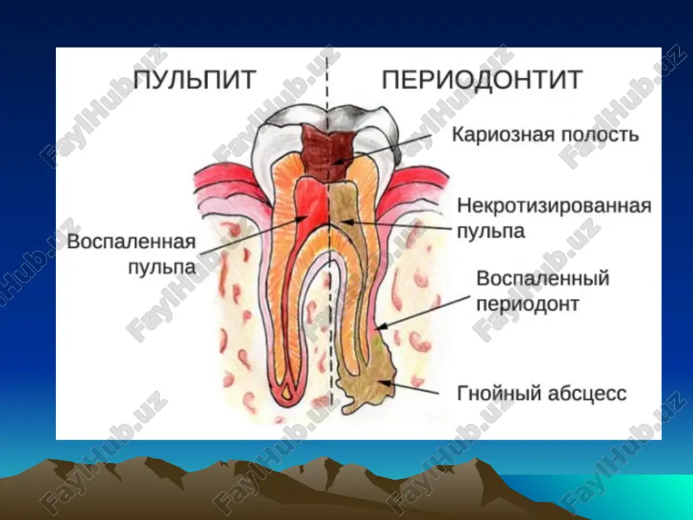 yutsya: differentsialnaya diagnostika ostrogo diffuznogo pulpita, ostrogo verxushechnogo periodontita i xronicheskogo verxushechnogo periodontita v stadii obostreniya. 1). pri ostrom diffuznom pulpite bol periodicheskaya, a pri ostrix formax verxushechnogo periodontita ona postoyannaya, narastayushaya vo vremeni, tak kak idet skoplenie ekssudata v zamknutom prostranstve periodontalnoy sheli, bez promejutkov; 2). pri ostrom diffuznom pulpite polost zuba obichno vskrita, a pri periodontite imeetsya soobshenie s pulpovoy kameroy, bezboleznennoe pri zondirovanii; 3). pri ostrom diffuznom pulpite palpatsiya po perexodnoy skladke v oblasti proektsii bolnogo zuba bezboleznenna, a pri ostrix formax periodontita-boleznenna; 4). pri ostrom diffuznom pulpite perkussiya mojet bit lish slaboboleznennoy, a pri ostrix formax periodontita do zuba bolno dotronutsya daje yazikom. 5). pri ostrom diffuznom pulpite patsient ne mojet tochno ukazat bolnoy zub iz-za irradiatsii boli, v otlichie ot ostrix form periodontita; 6). pri ostrom diffuznom pulpite temperaturnie razdrajiteli provotsiruyut bol, a pri ostrix formax periodontita bolevaya reaktsiya na temperaturnie razdrajiteli otsutstvuet; 7) pokazateli …
