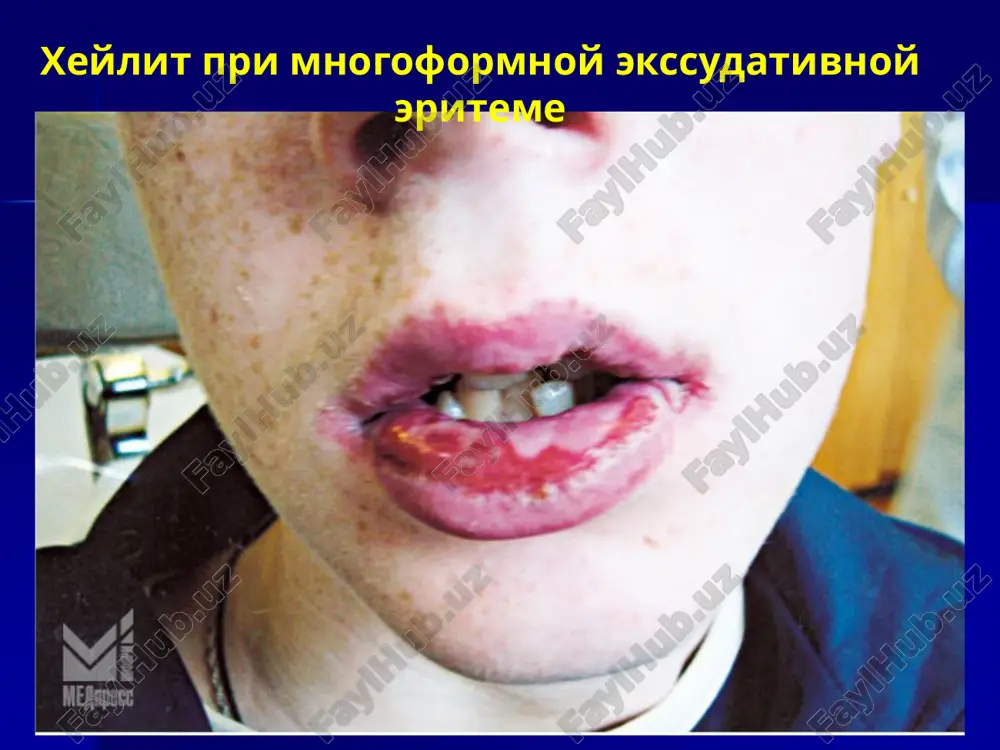 menenii fotozashitnix mazey i kremov. aktinicheskiy xeylit, ekssudativnaya forma v patogeneze xeylitov, ravno kak i v podderjanii gomeostaza, imeet znachenie gruppa «obmennix» funktsiy koji i slizistoy obolochki polosti rta, v chastnosti visokaya aktivnost koji i slizistoy obolochki k vsasivaniyu razlichnix veshestv s poverxnosti. xeylit pri ostrom gerpeticheskom stomatite zabolevaniya gub u detey proisxodyat preimushestvenno v svyazi s generalizovannoy patologiey koji v detskom vozraste (allergicheskiy diatez, ekzema, neyrodermit, gipovitaminoz i dr.) neyrodermicheskiy xeylit, perexodyashiy v eksfoliativnuyu formu tyajelaya forma xeylita pri neyrodermite tyajelaya forma xeylita pri neyrodermite libo s narusheniem usloviy fiziologicheskogo sostoyaniya gub (nepolnoe ili nepravilnoe smikanie). slizistaya obolochka, prisposoblennaya k teploy, vlajnoy srede, podvergaetsya visushivaniyu, vozdeystviyu nizkix temperatur, solnechnix luchey i t.d. xronicheskaya treshina nijney gubi uvlajnenie gub putem oblizivaniya slizistoy obolochki, tem ne menee, ne polnostyu zashishaet «ne zashishenniy» keratinom (kak u koji) ili xotya bi emidinom (kak u krasnoy kaymi) epiteliy. razvivayutsya priznaki ego vospaleniya: suxost, giperemiya, …