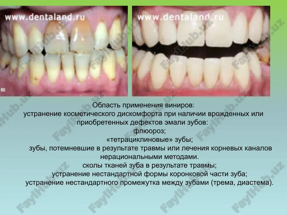 sutstvie temnoy kaemki polnoe otsutstvie metalla prevosxodnaya biosovmestimost chrezvichayno visokaya prochnost dolgovechnost bezvredniy sostav (otsutstvie oksida kremniya) - ochen nizkaya rastvoryaemost ,visokaya stabilnost po otnosheniyu k kislotam. - gladkaya poverxnost, prepyatstvuyushaya akkumulyatsii nalyota. - absolyutnaya bioinertnost po otnosheniyu k drugim materialam v polosti rta . - visokie teploizolyatsionnie svoystva ,pozvolyayushie v polnoy mere naslajdatsya priyomom xolodnoy ili goryachey pishi ili napitkov potentsialnie protivopokazaniya dlya primeneniya bezmetallovoy keramiki na osnove oksida tsirkoniya: - nalichie nizkoy klinicheskoy visoti estestvennix zubov (melkie zubi) v oblasti konnektorov mostovidnogo proteza; - glubokiy prikus; - bruksizm; ploshad zon sochleneniya otdelnix elementov v karkase mostovidnogo proteza ne doljna bit menee 9 mm2. ne rekomenduetsya izgotovlenie vnutrikornevix kultevix vkladok iz oksida tsirkoniya. k osnovnim materialam v proizvodstve tsirkonievix protezov otnosyatsya: - bloki tsirkoniya; - jidkost dlya okrashivaniya dioksida tsirkoniya pered sinterizaitsey; - plastmassa poliuretanovaya samopolimerizuyushayasya (framea&b); - kompozit svetootverjdaemiy (rigid); - massa keramicheskaya dlya napekaniya na tsirkoniy; - …