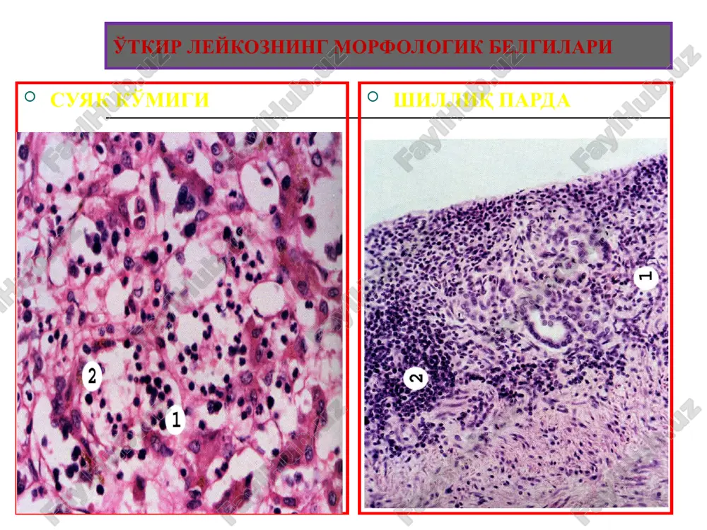 talassemiya bu- gemoglobinning a-globin va v-globin zanjirlari sintezi buzilishidan rivojlanadigan irsiy anemiyadir. sababi va mexanizmi: gemoglobin genlari mutatsiyasi, deletsiyasi va transkriptsiyasi, bekaron rnk sintezlanishi. patnatomiyasi: makro: splenomegaliya, gepatomegaliya, kumik giperplaziyasi, suyakning yupkalanishi, gemosideroz, sariklik. mikro: konda- anitsitoz, poykilotsitoz, retikulotsitoz. ektramedulyar gematopoez. rasm iii. diseritropoetik eritropoez buzilishi okibatida boshlanadigan anemiyalar suyak kumigining gemopoez uchun zarur moddalar bilan tegishliyaa ta'minlanmaginligidan kelib chikuvchi anemiyadir. turlari: 1.fe tankisligiga boglik anemiya 2.megaloblastik anemiya 3. gipoplastik va aplastik anemiya 4.mieloftiz anemiya 1. temir tankisligiga boglik anemiya sababi: a) alimentar temir etishmovchiligi; b) organizning temir moddasiga extiyoji ortishi; v) temir moddasining me'da ichak traktidan surilishining buzilishi. mexanizmi: gemoglobin sintezida ishtrok etuvchi va uz tarkibida temir saklovchi fermentlarning temir etishmasligi natijasida sintezining susayish, gem sintezi uchun zarur fe +2 ning etishmasligi natijasidagemoglobin sintezining susayishi. okibati: 1. me'da ichak yullarida atrofik jarayonlar 2. atrofik glossit,gingivit,plammer-vinson sindromi; 3. miokard eg distrofiyasi; 4. jigar eg distrofiyasi. makro: - teri va shillik …